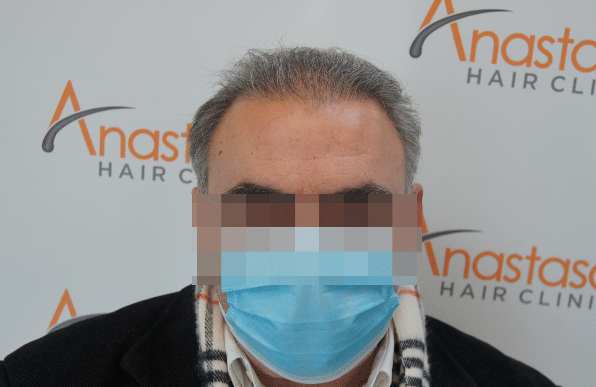 hair transplant patient result with 3000 fus before - fullface