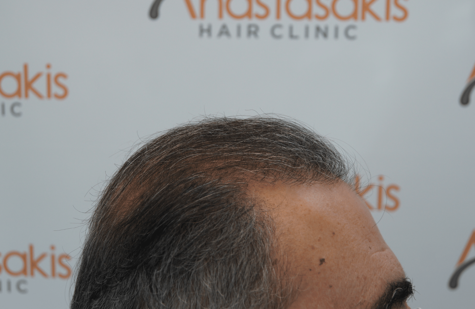 hair transplant patient result with 3000 fus before - side3