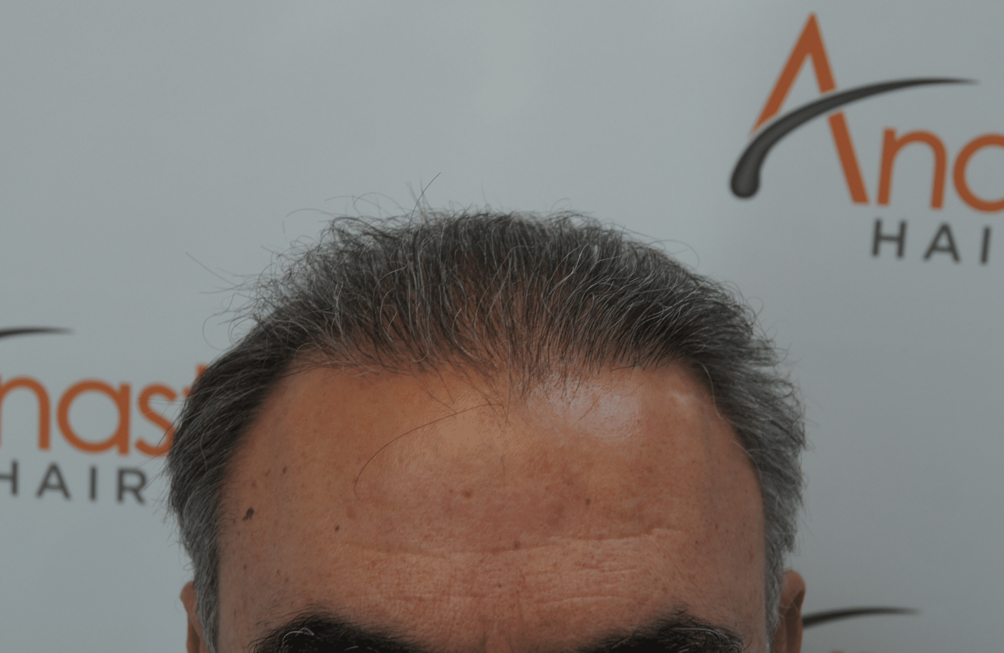 hair transplant patient result with 3000 fus before - hairline
