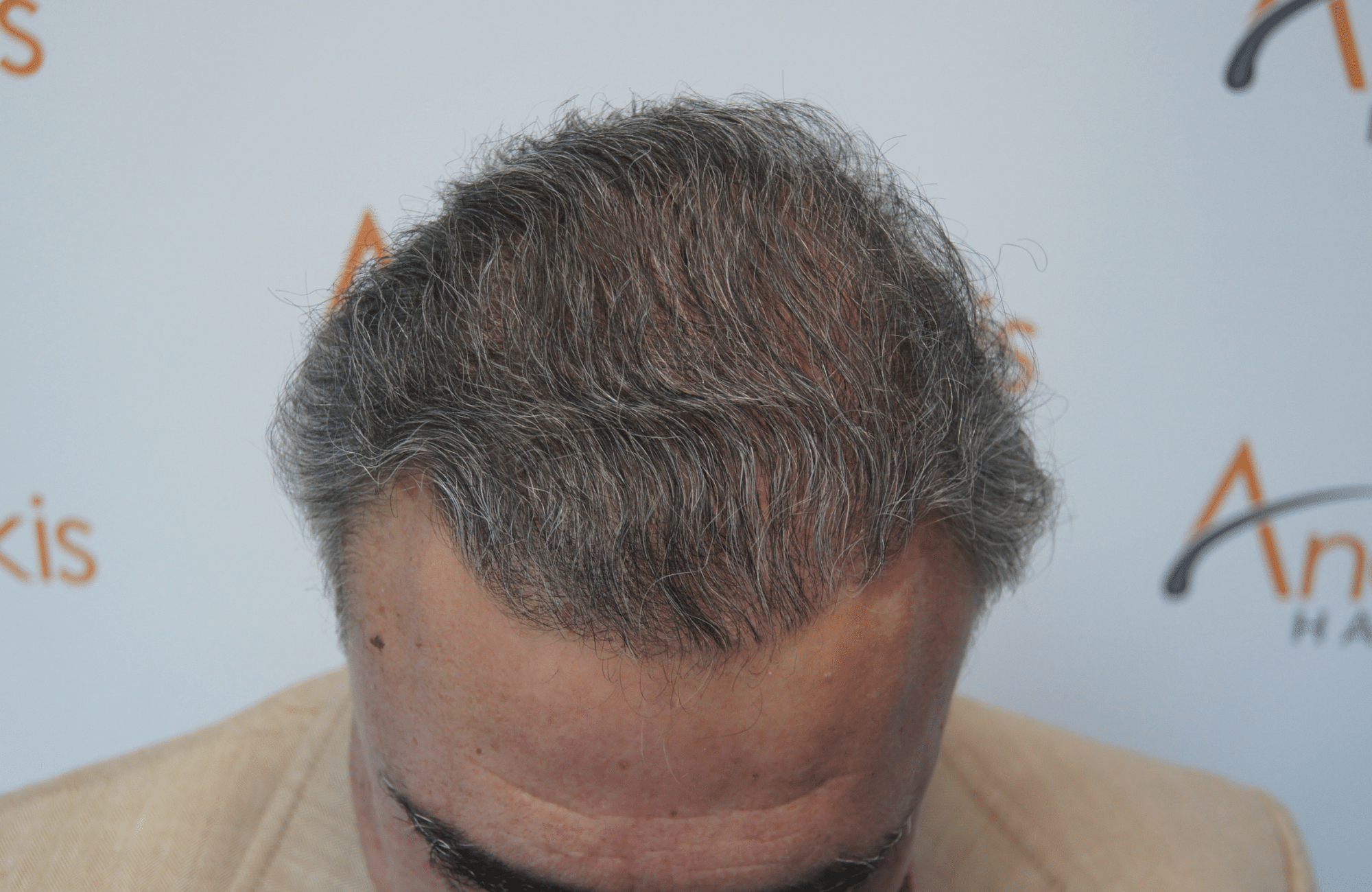 hair transplant patient result with 3000 fus after - frontal