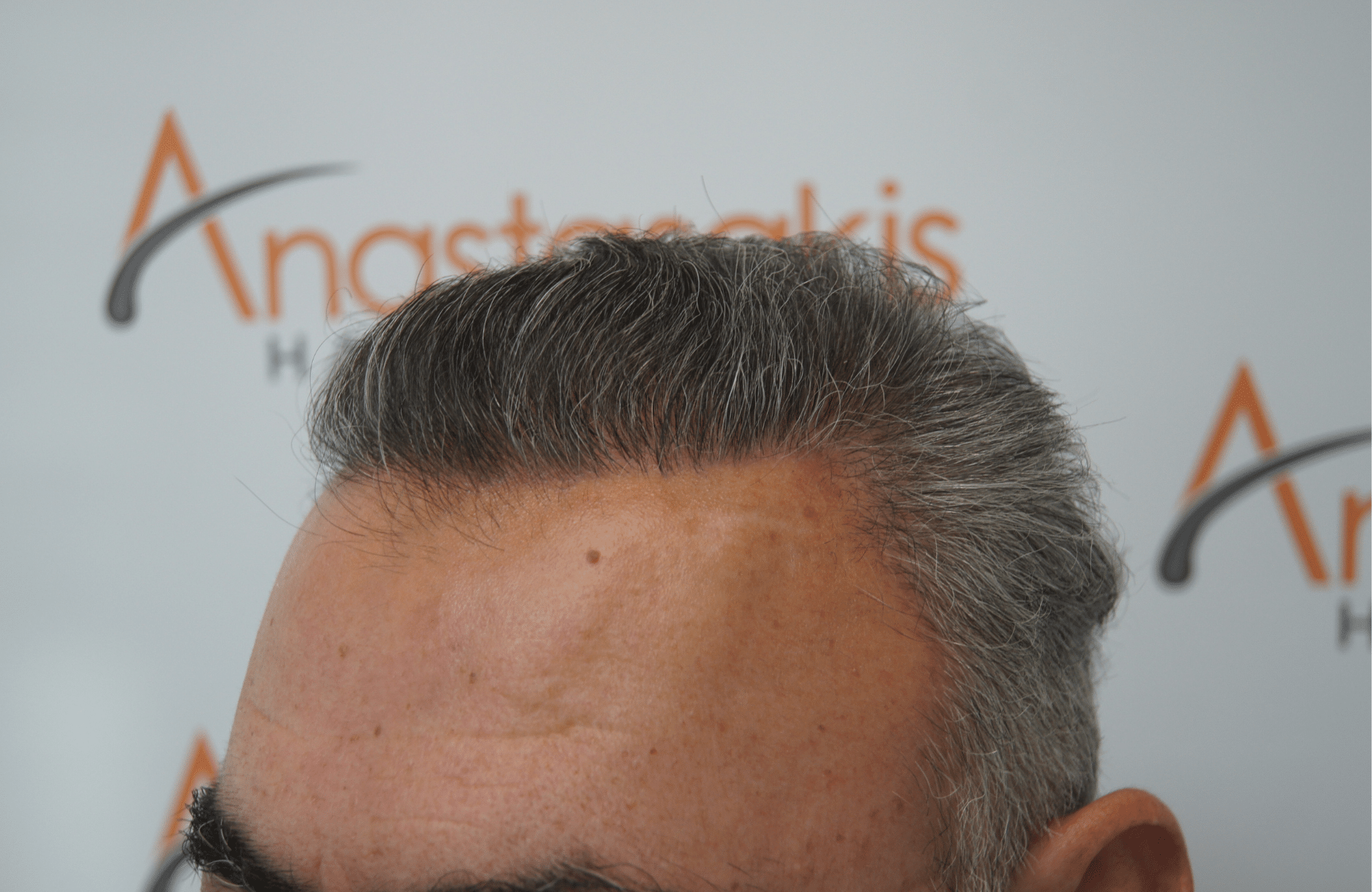 hair transplant patient result with 3000 fus after - side1