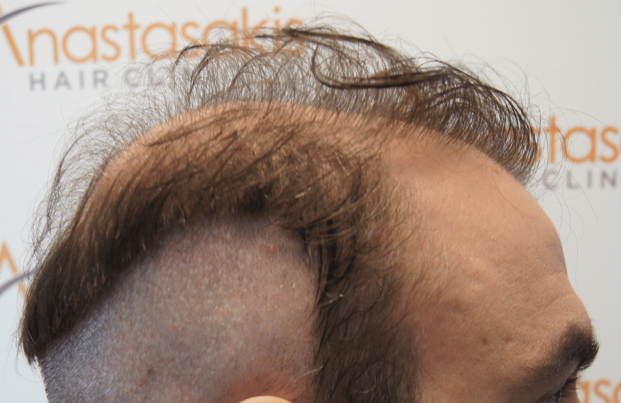 hair transplant patient result with 3000 fus before - side1