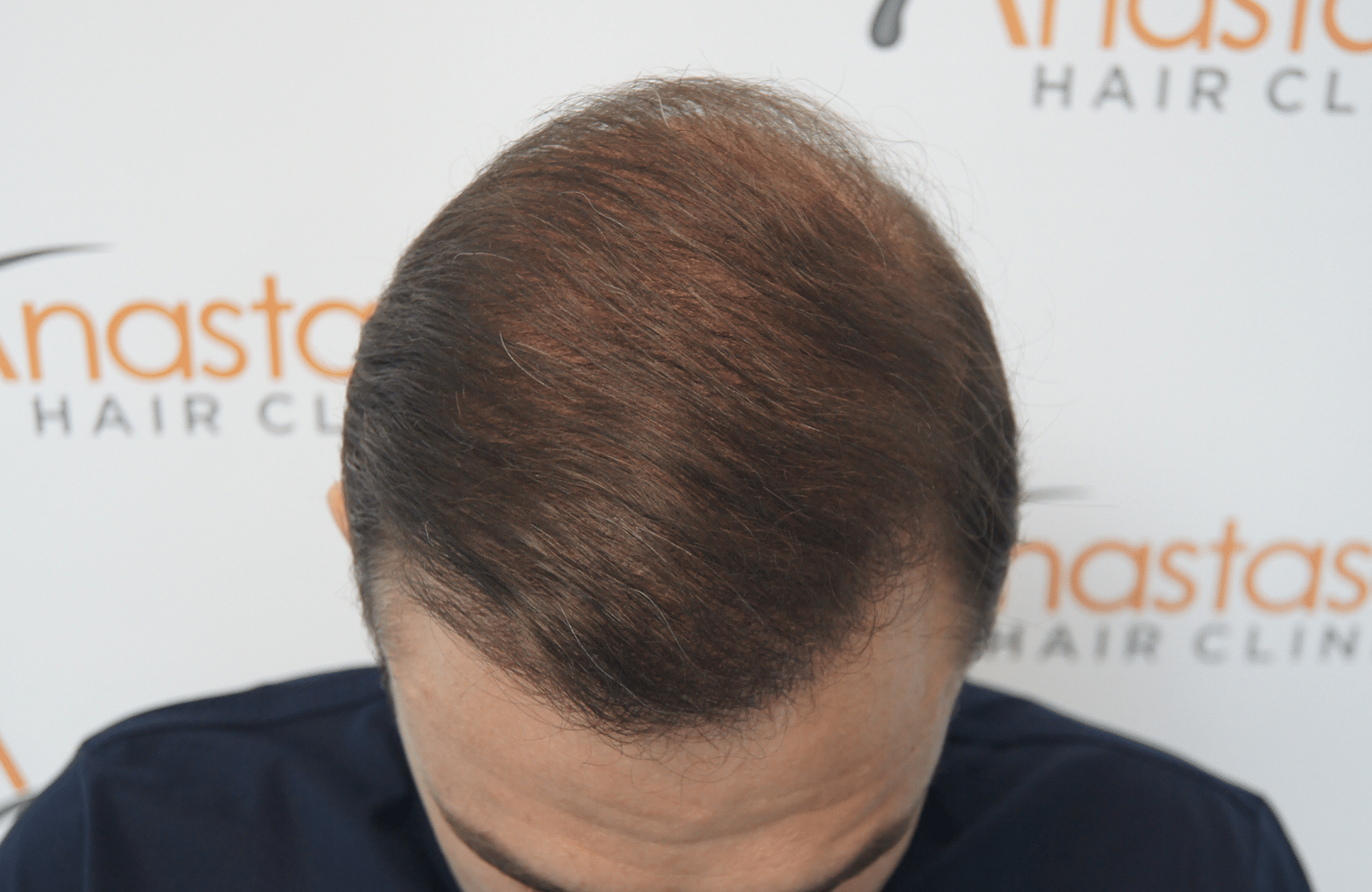 hair transplant patient result with 3000 fus after - frontal