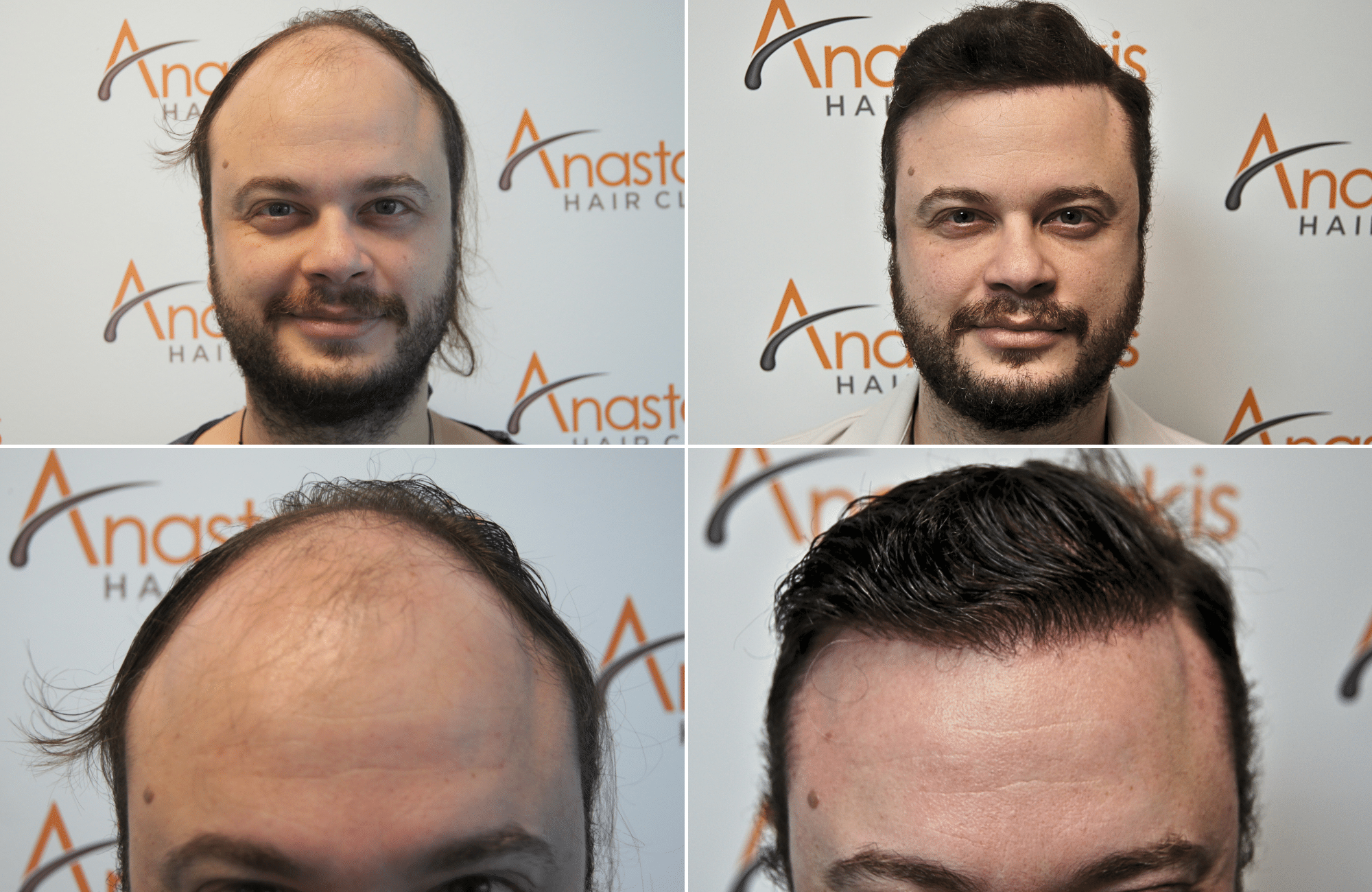 https://www.anastasakishairclinic.gr/portfolio/apotelesma-metamosxefsis-mallion-anastasakis-hair-clinic-422/