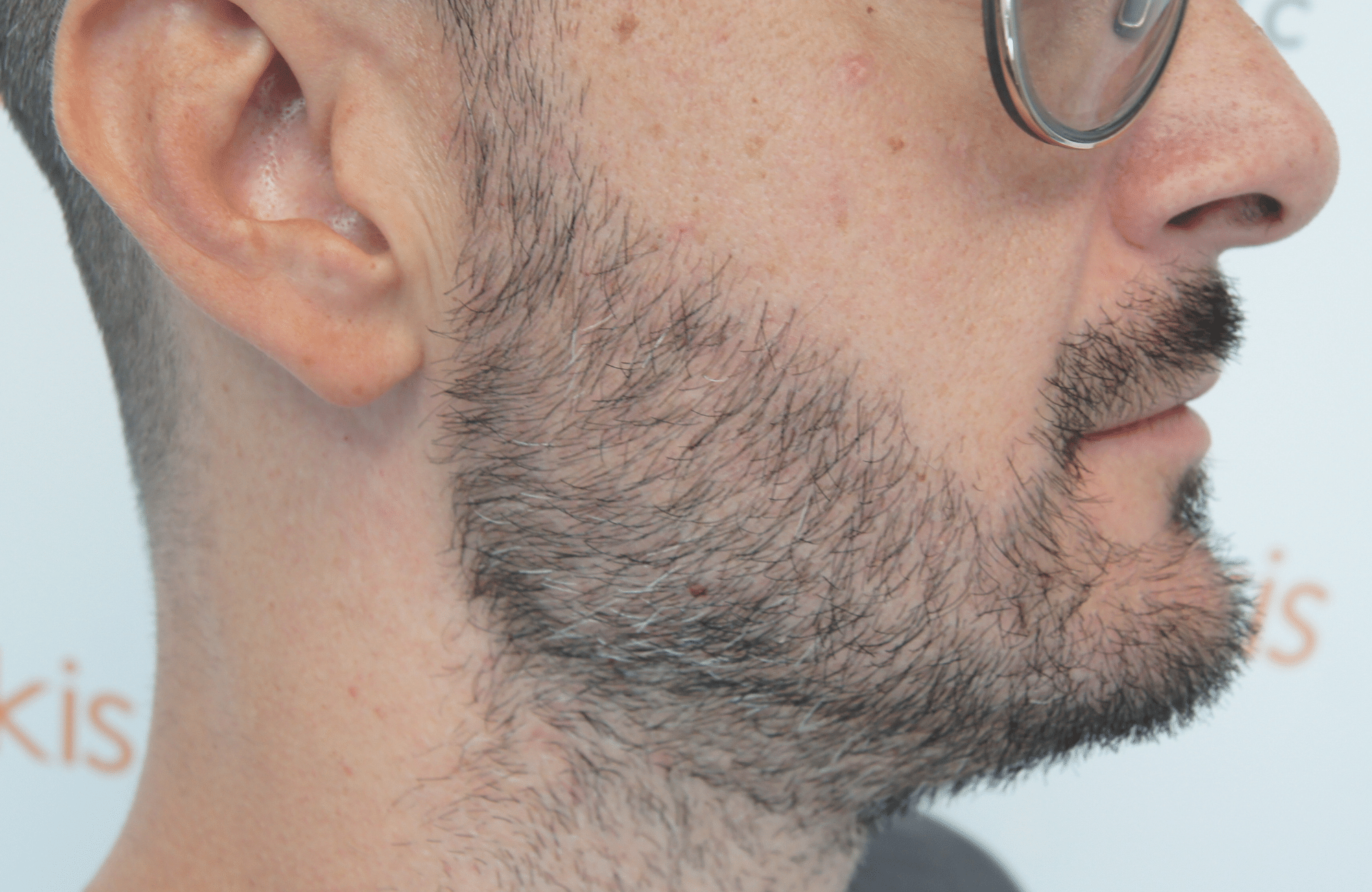 beard transplant result with 1000 follicular units - after side4