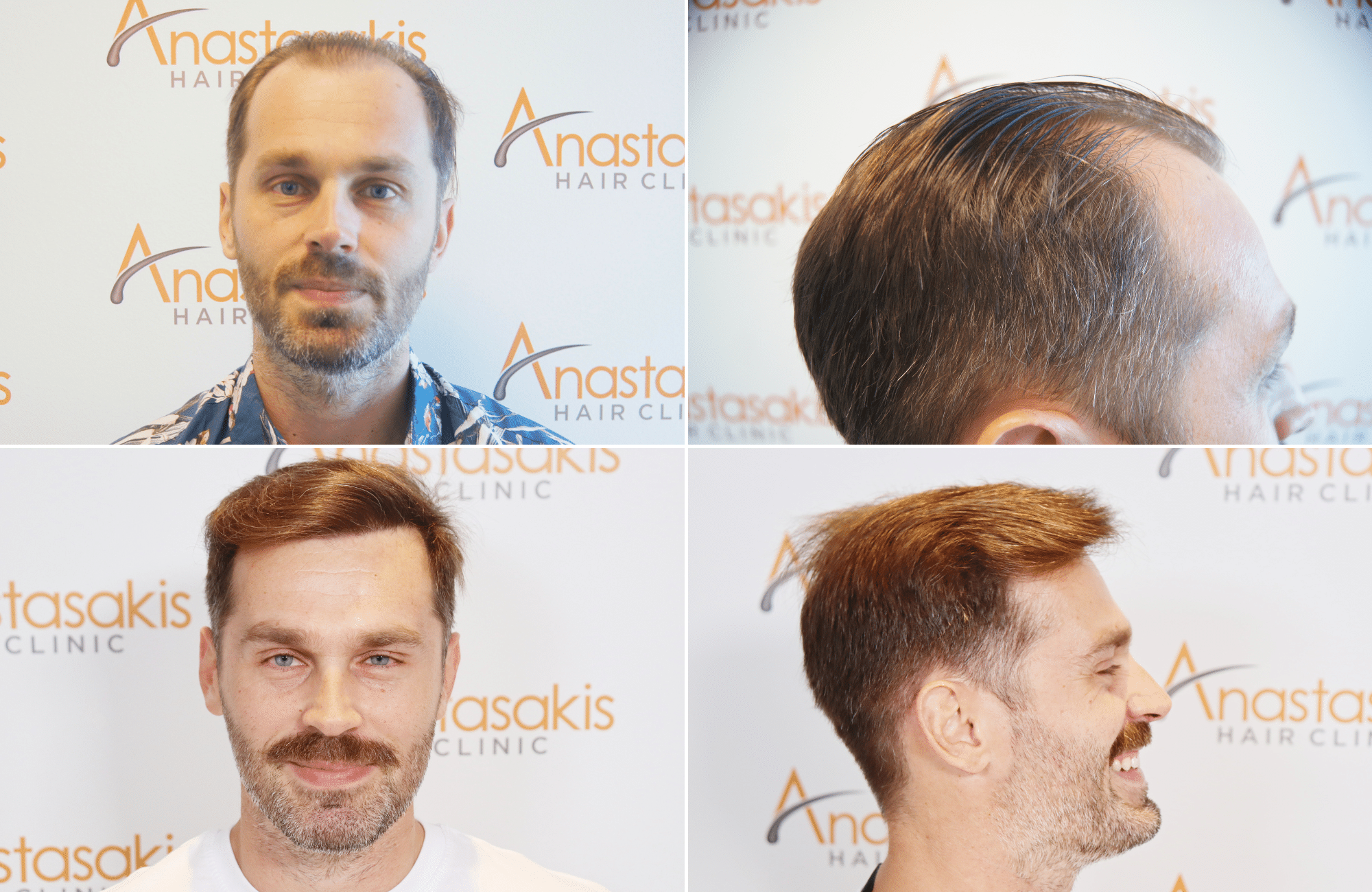 https://www.anastasakishairclinic.gr/portfolio/apotelesma-metamosxefsis-mallion-anastasakis-hair-clinic-318/