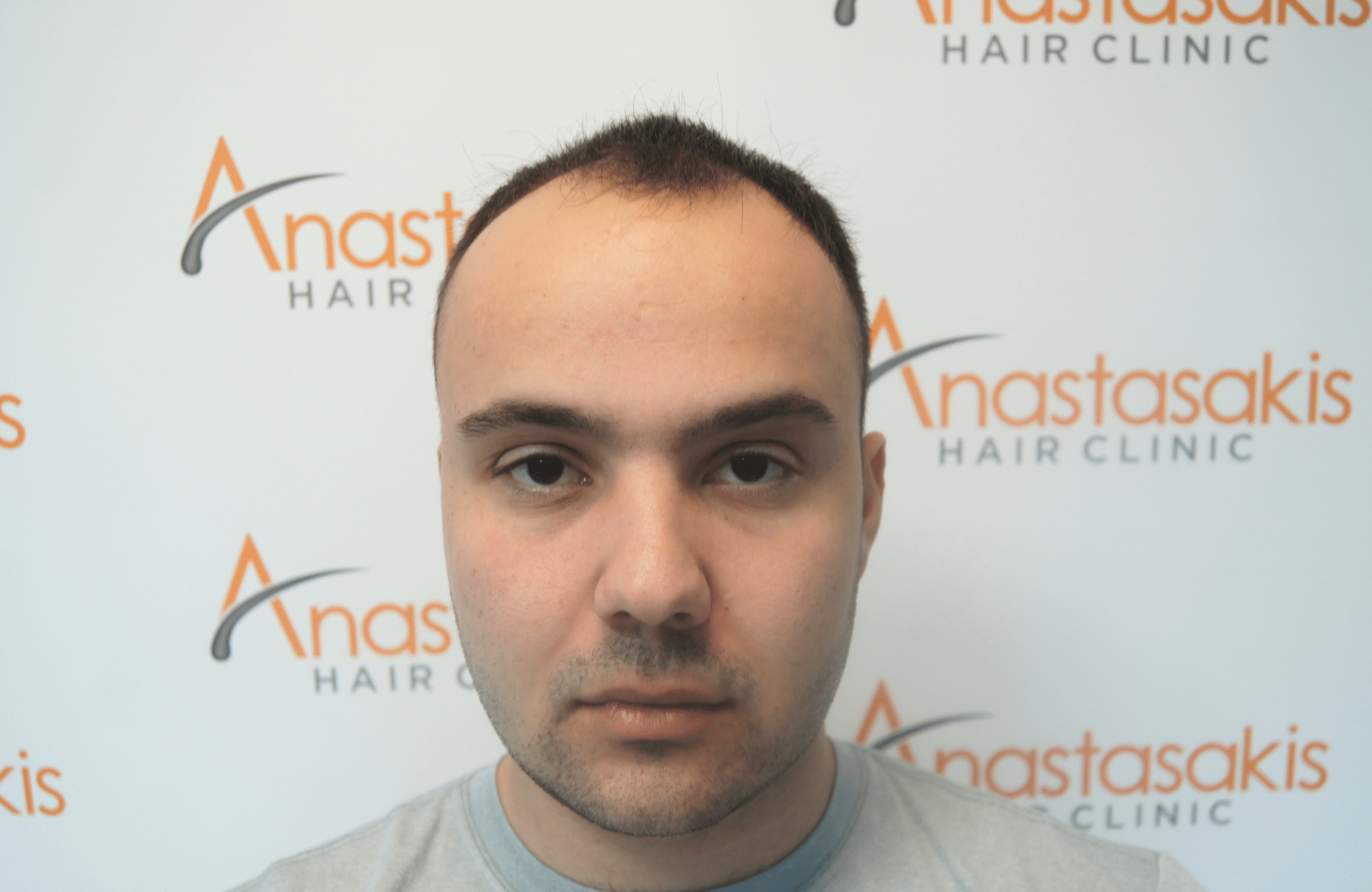 hair transplant result