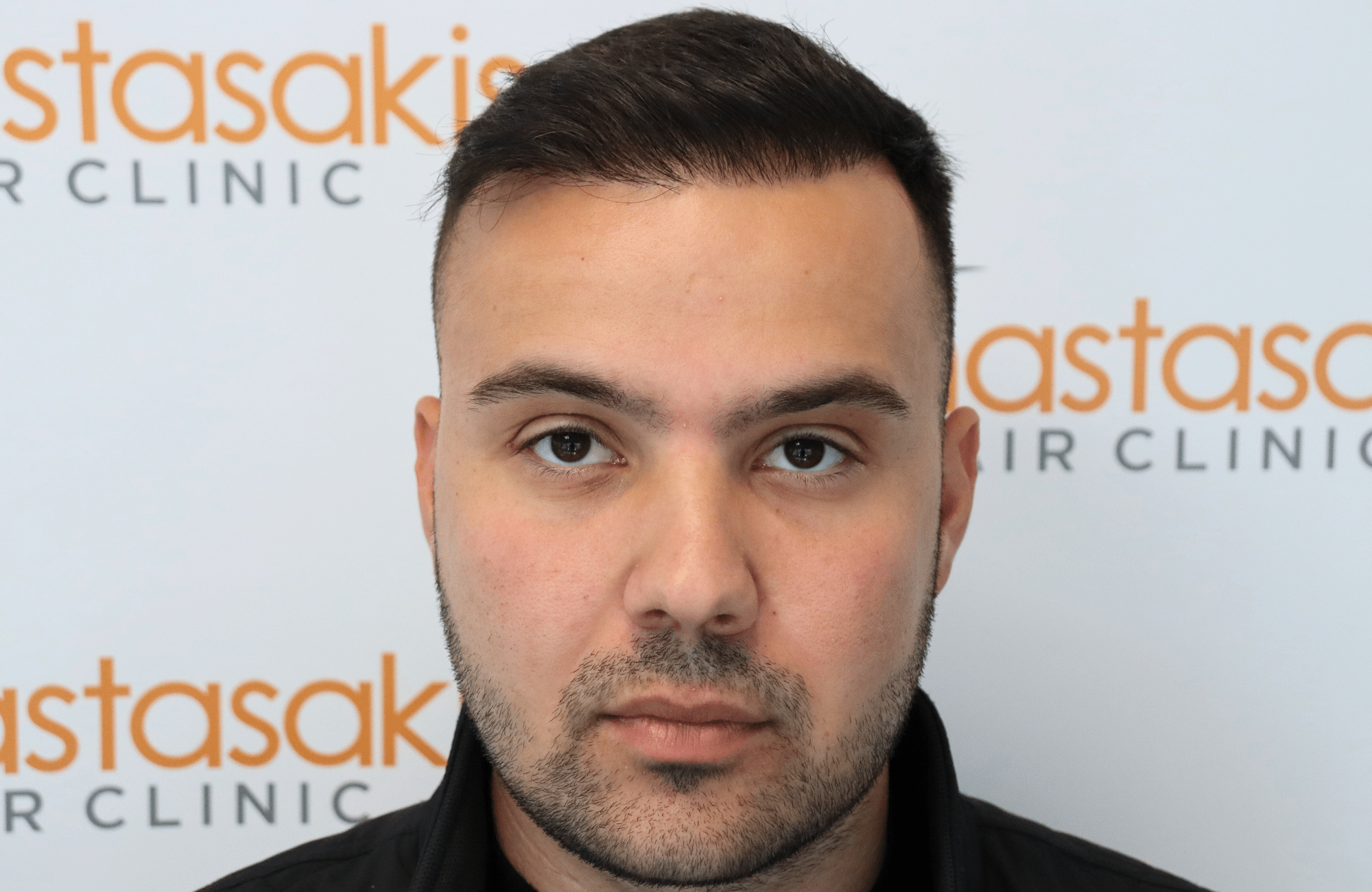hair transplant result