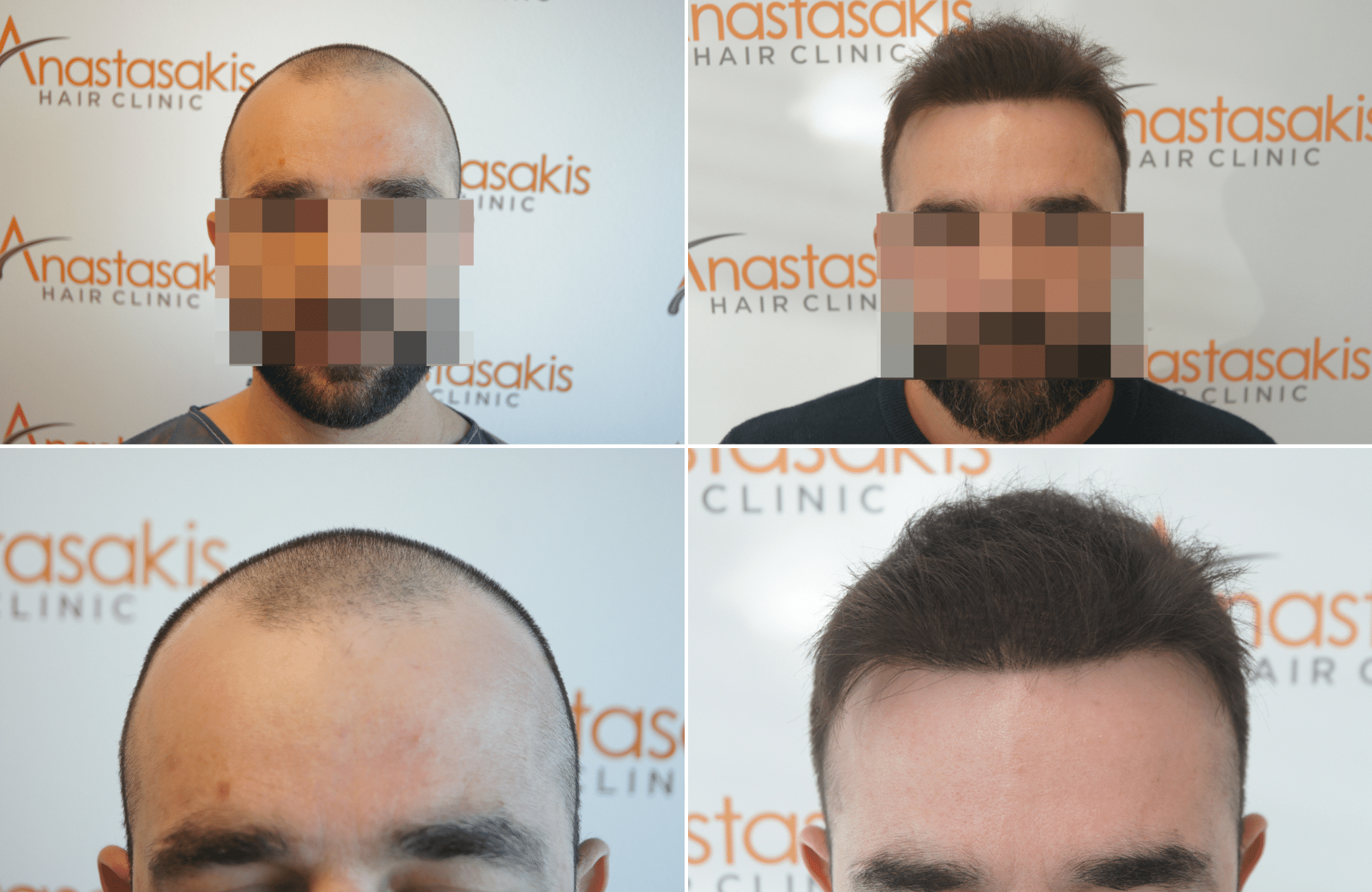 https://www.anastasakishairclinic.gr/portfolio/apotelesma-metamosxefsis-mallion-anastasakis-hair-clinic-409/