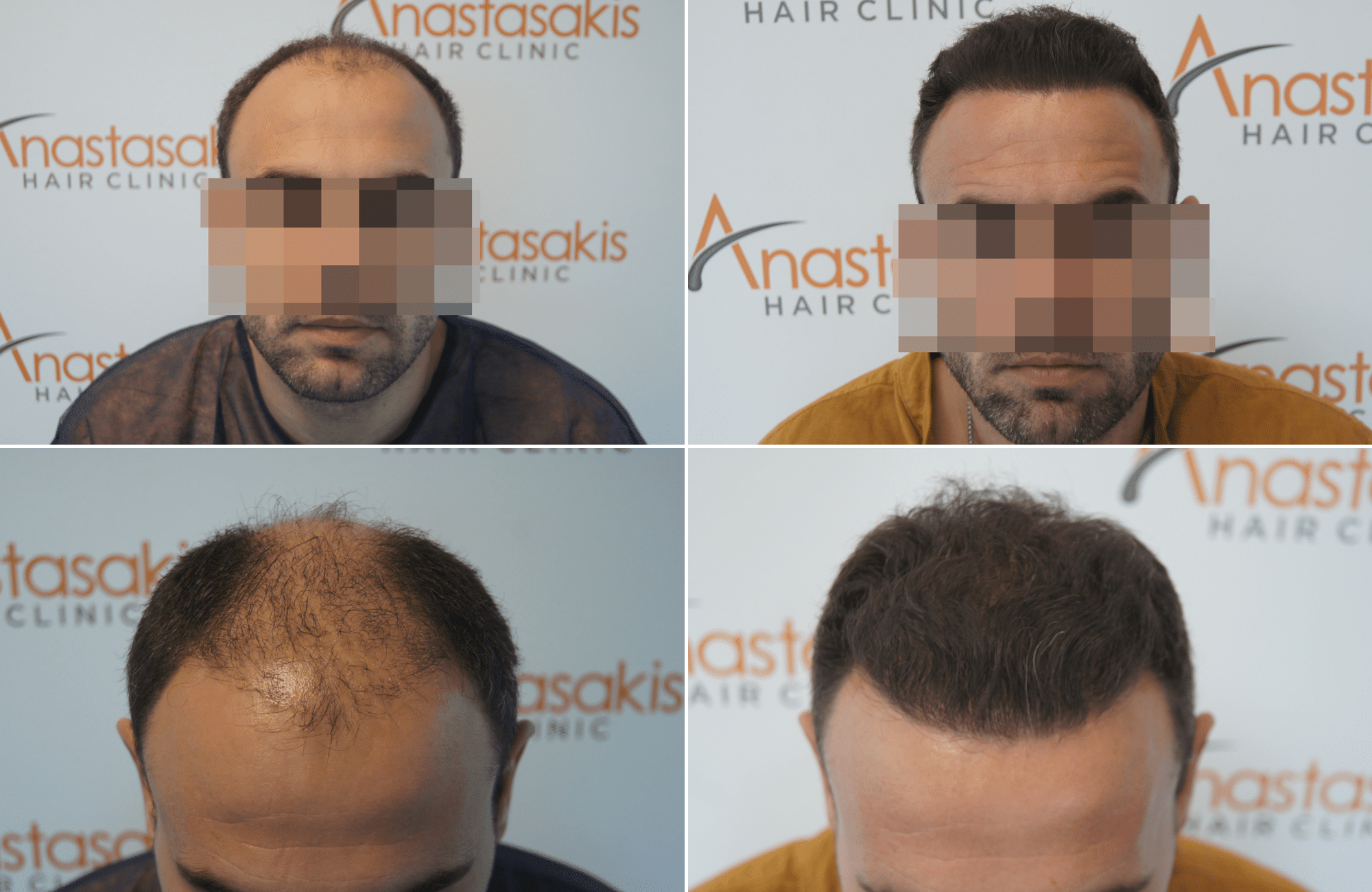 https://www.anastasakishairclinic.gr/portfolio/apotelesma-metamosxefsis-mallion-anastasakis-hair-clinic-410/