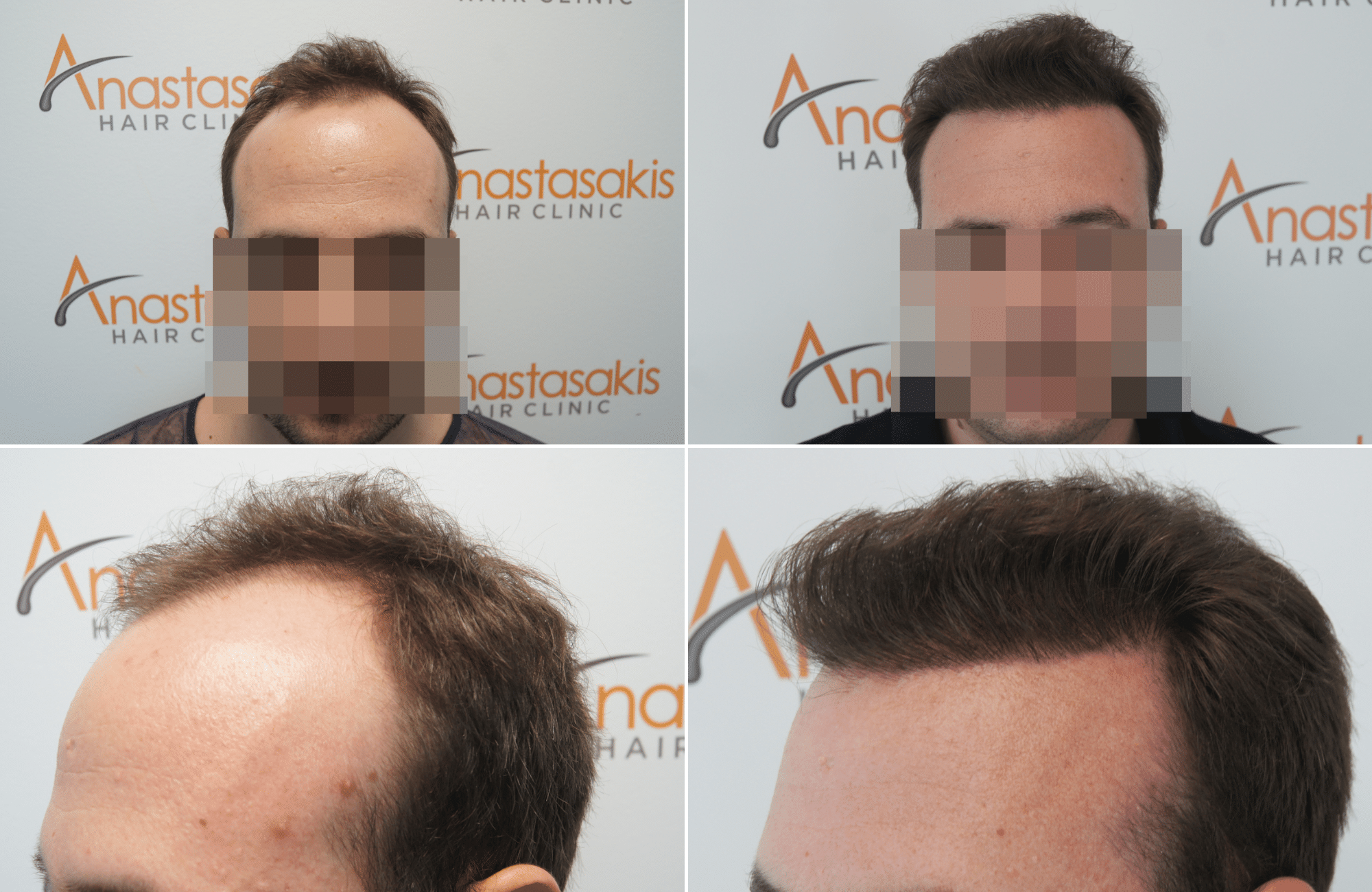 https://www.anastasakishairclinic.gr/portfolio/apotelesma-metamosxefsis-mallion-anastasakis-hair-clinic-412/