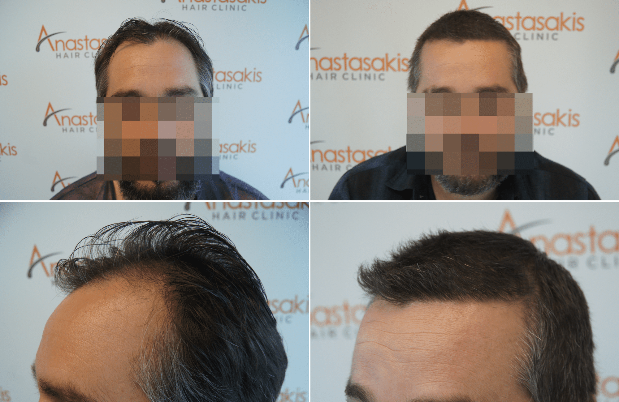 https://www.anastasakishairclinic.gr/portfolio/apotelesma-metamosxefsis-mallion-anastasakis-hair-clinic-423/