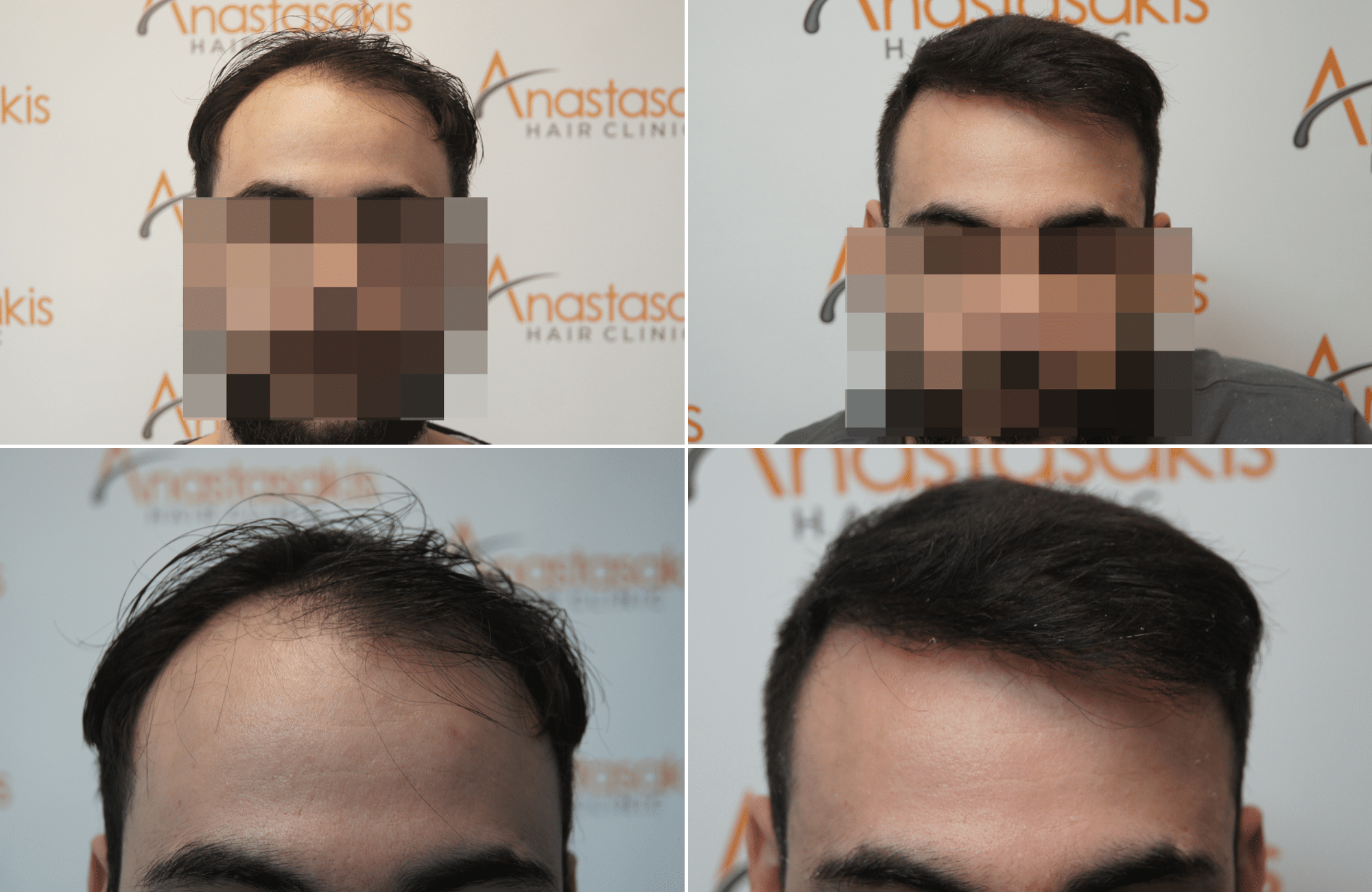 https://www.anastasakishairclinic.gr/portfolio/apotelesma-metamosxefsis-mallion-anastasakis-hair-clinic-425/
