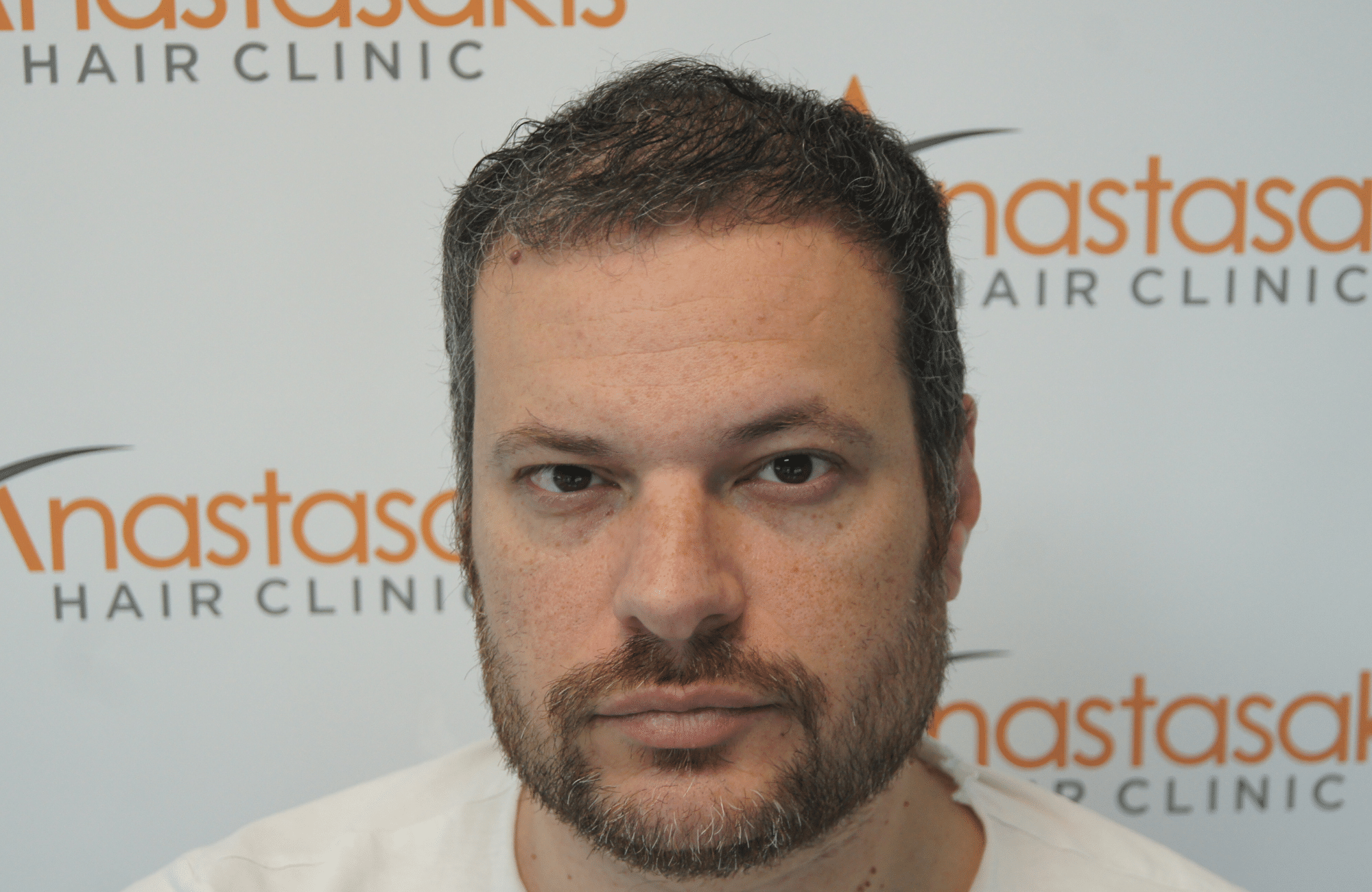 hair transplant result with 3500 grafts - before - fullface