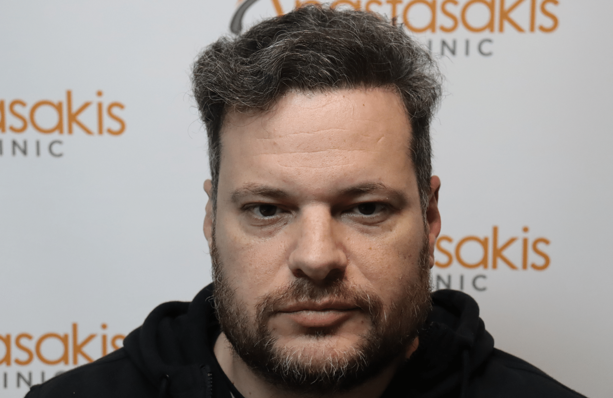 hair transplant result with 3500 grafts - after - fullface