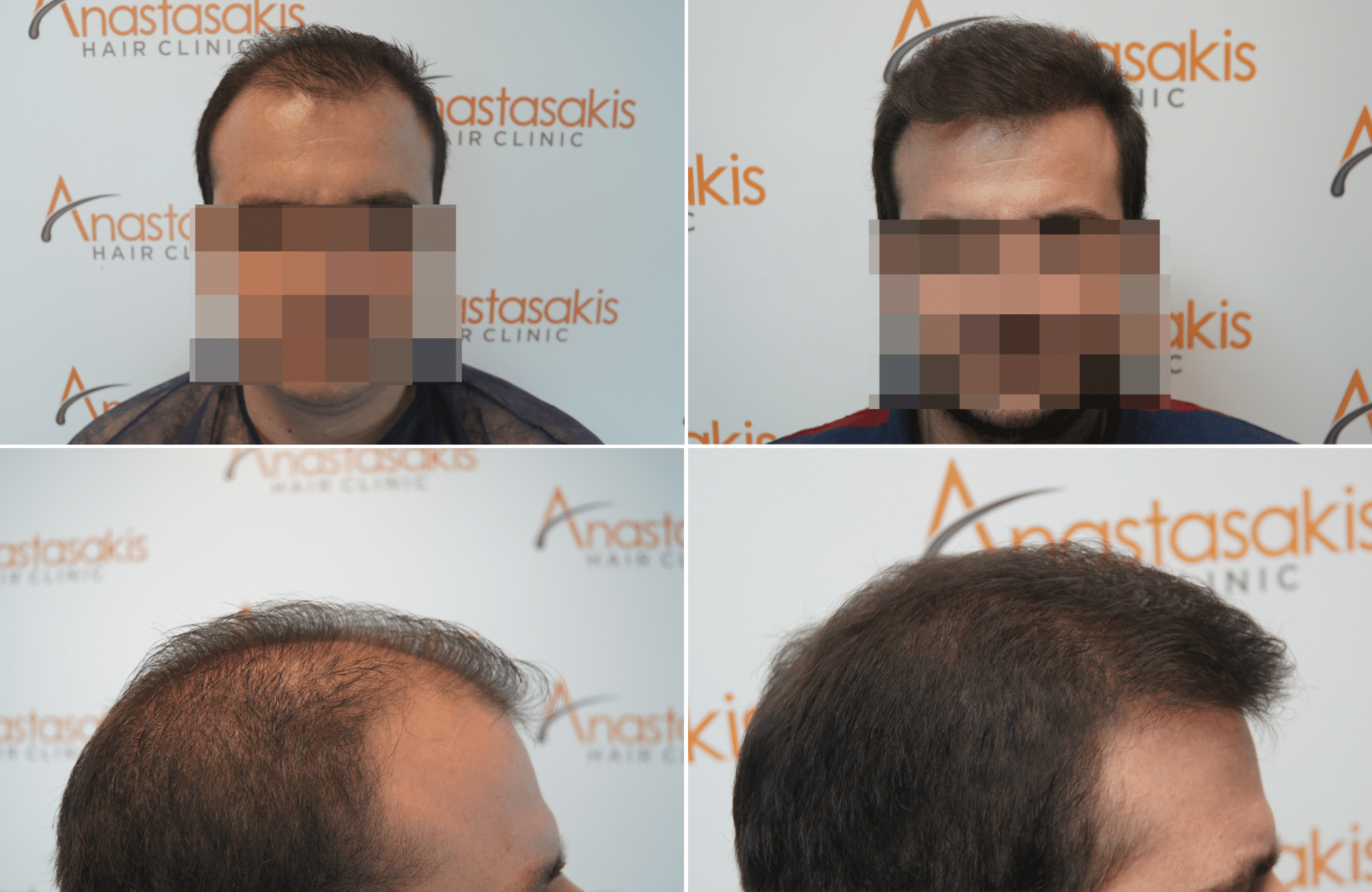 https://www.anastasakishairclinic.gr/portfolio/apotelesma-metamosxefsis-mallion-anastasakis-hair-clinic-424/