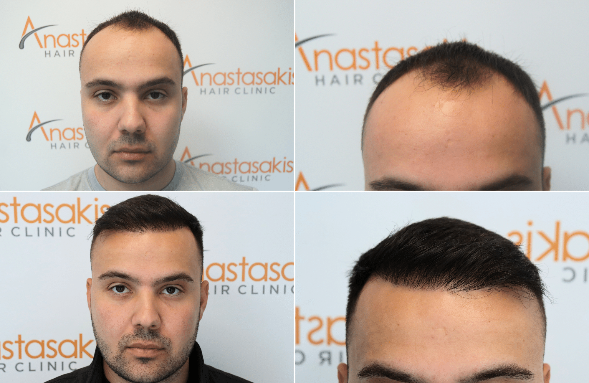 https://www.anastasakishairclinic.gr/portfolio/apotelesma-metamosxefsis-mallion-anastasakis-hair-clinic-183/