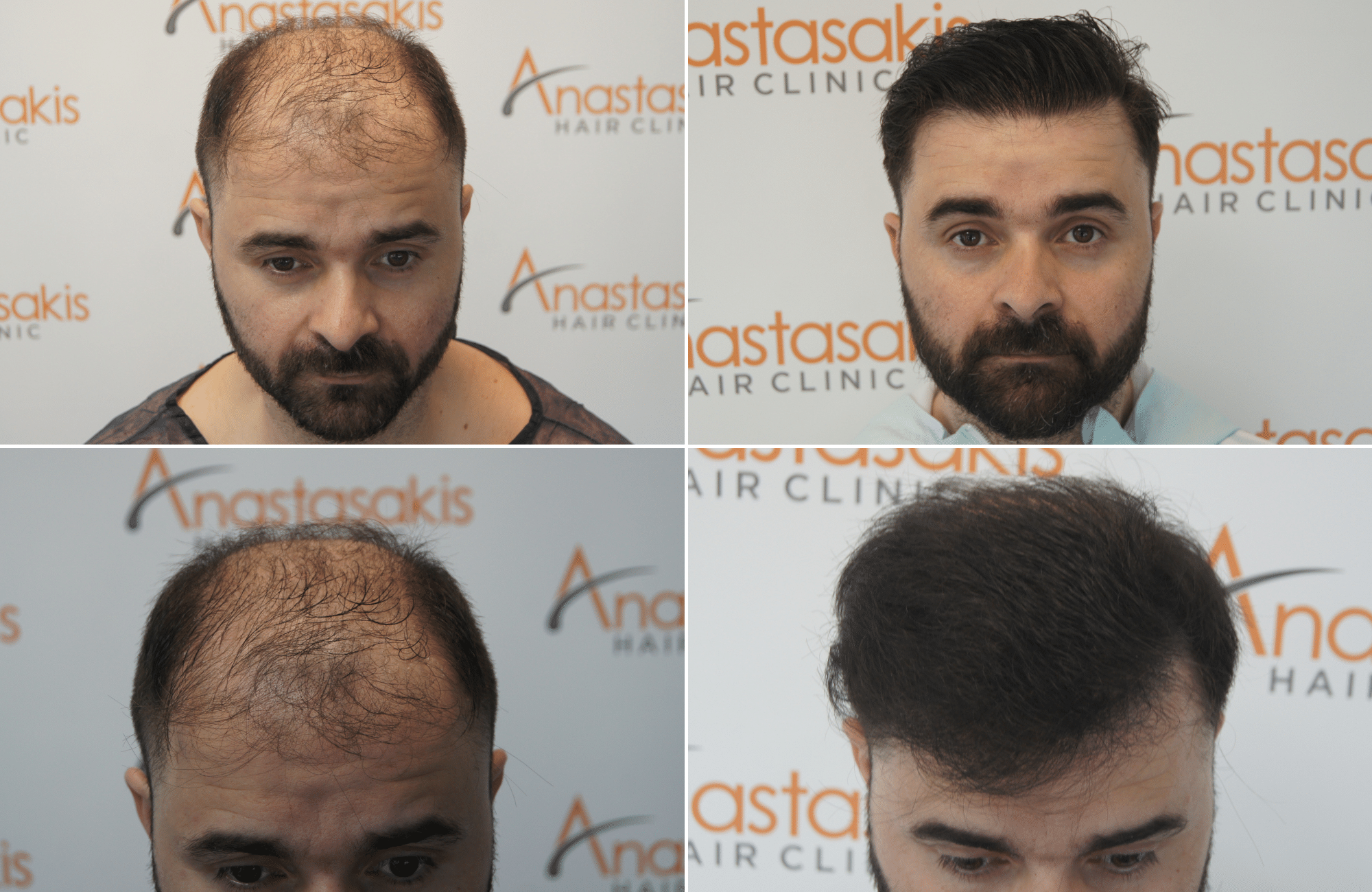 https://www.anastasakishairclinic.gr/portfolio/apotelesma-metamosxefsis-mallion-anastasakis-hair-clinic-457/