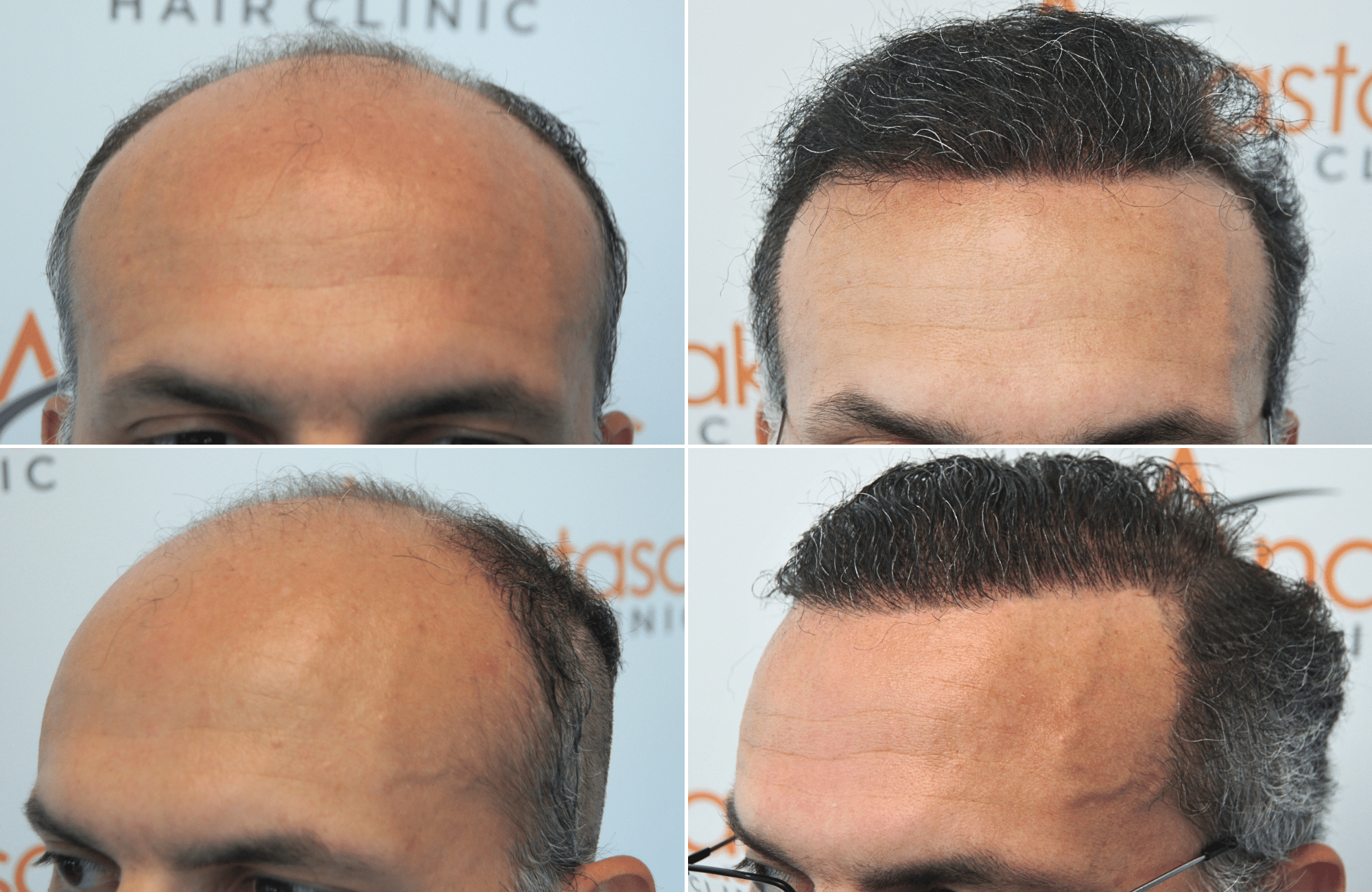 https://www.anastasakishairclinic.gr/portfolio/apotelesma-metamosxefsis-mallion-anastasakis-hair-clinic-454/