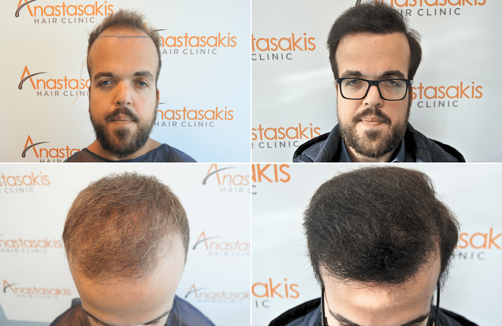 https://www.anastasakishairclinic.gr/portfolio/apotelesma-metamosxefsis-mallion-anastasakis-hair-clinic-456/