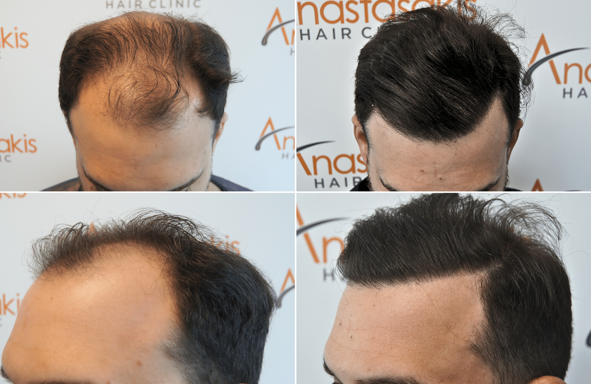 https://www.anastasakishairclinic.gr/portfolio/apotelesma-metamosxefsis-mallion-anastasakis-hair-clinic-459/