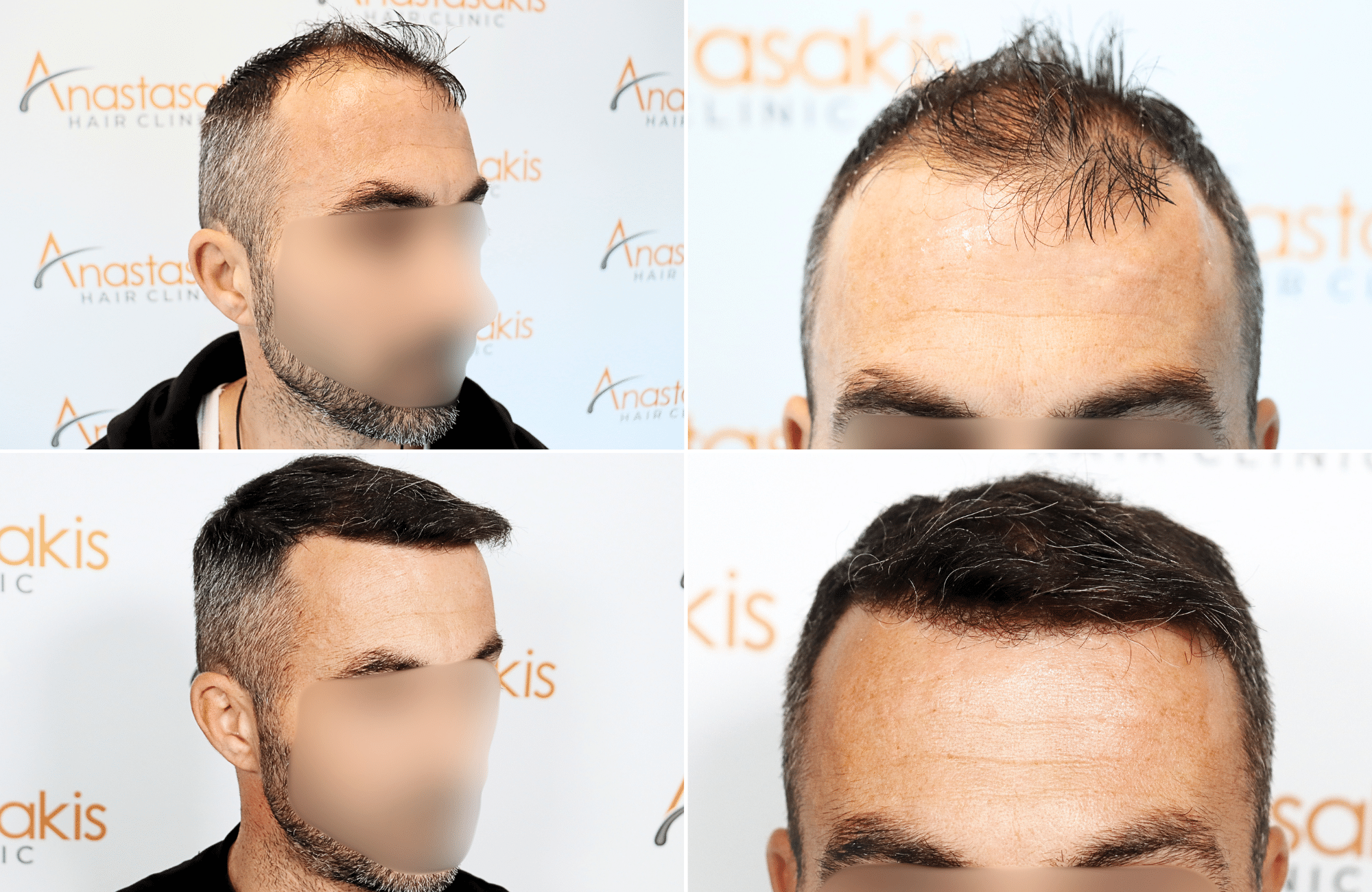https://www.anastasakishairclinic.gr/portfolio/apotelesma-metamosxefsis-mallion-anastasakis-hair-clinic-254/