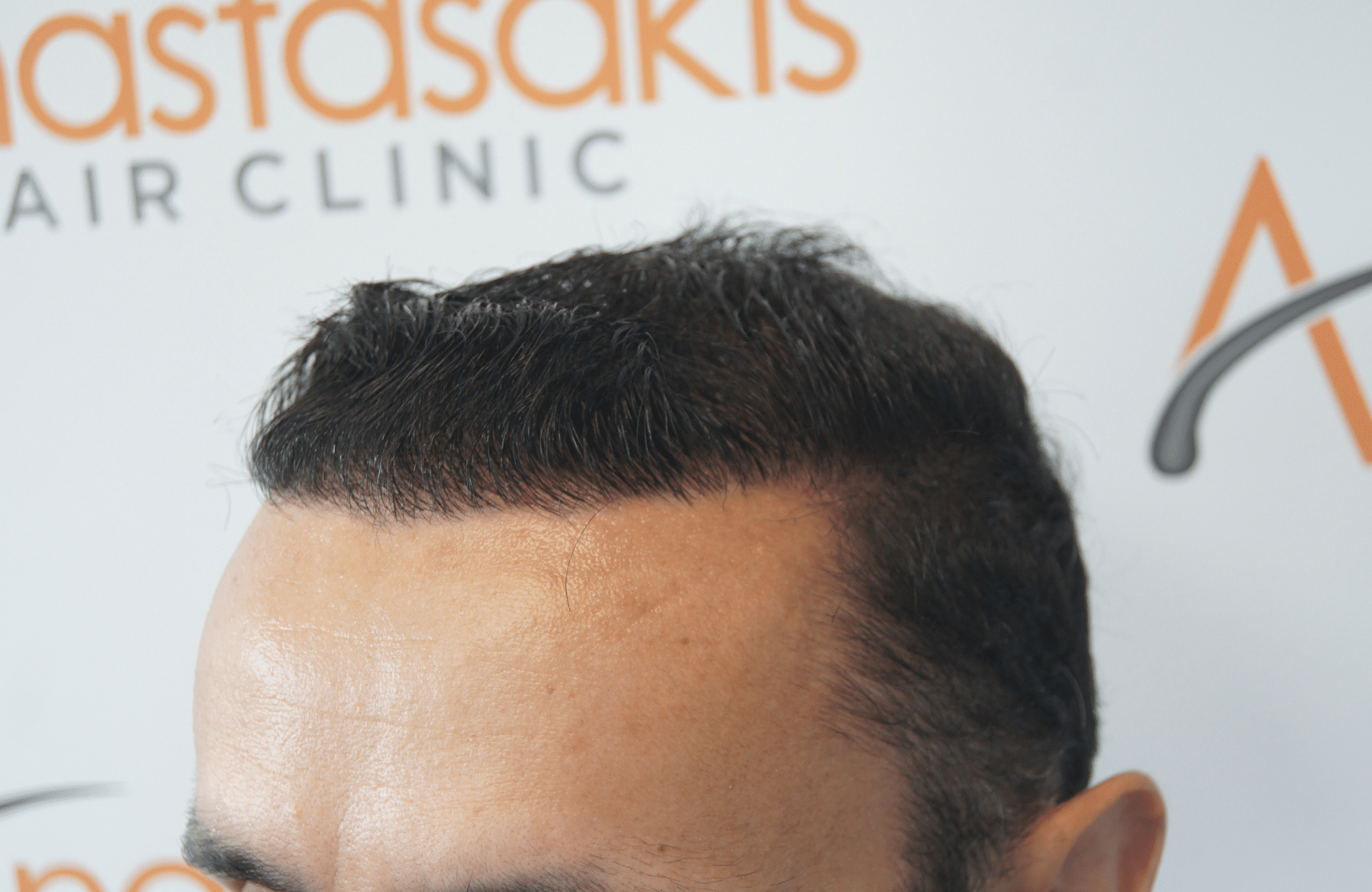 after hair transplant with 2500 fus in anastasakis hair clinic side1 wet hair
