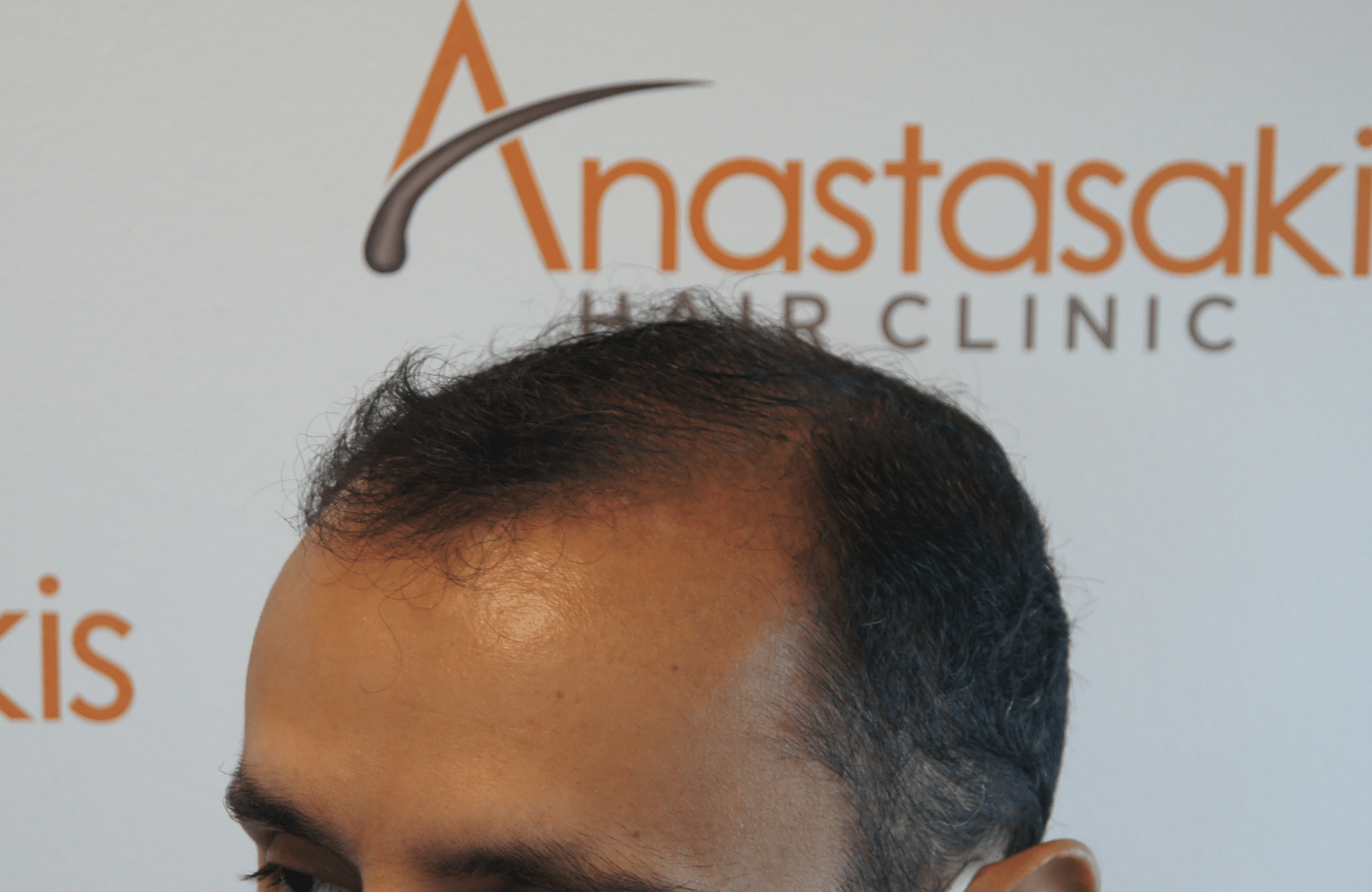 before hair transplant in anastasakis hair clinic side2