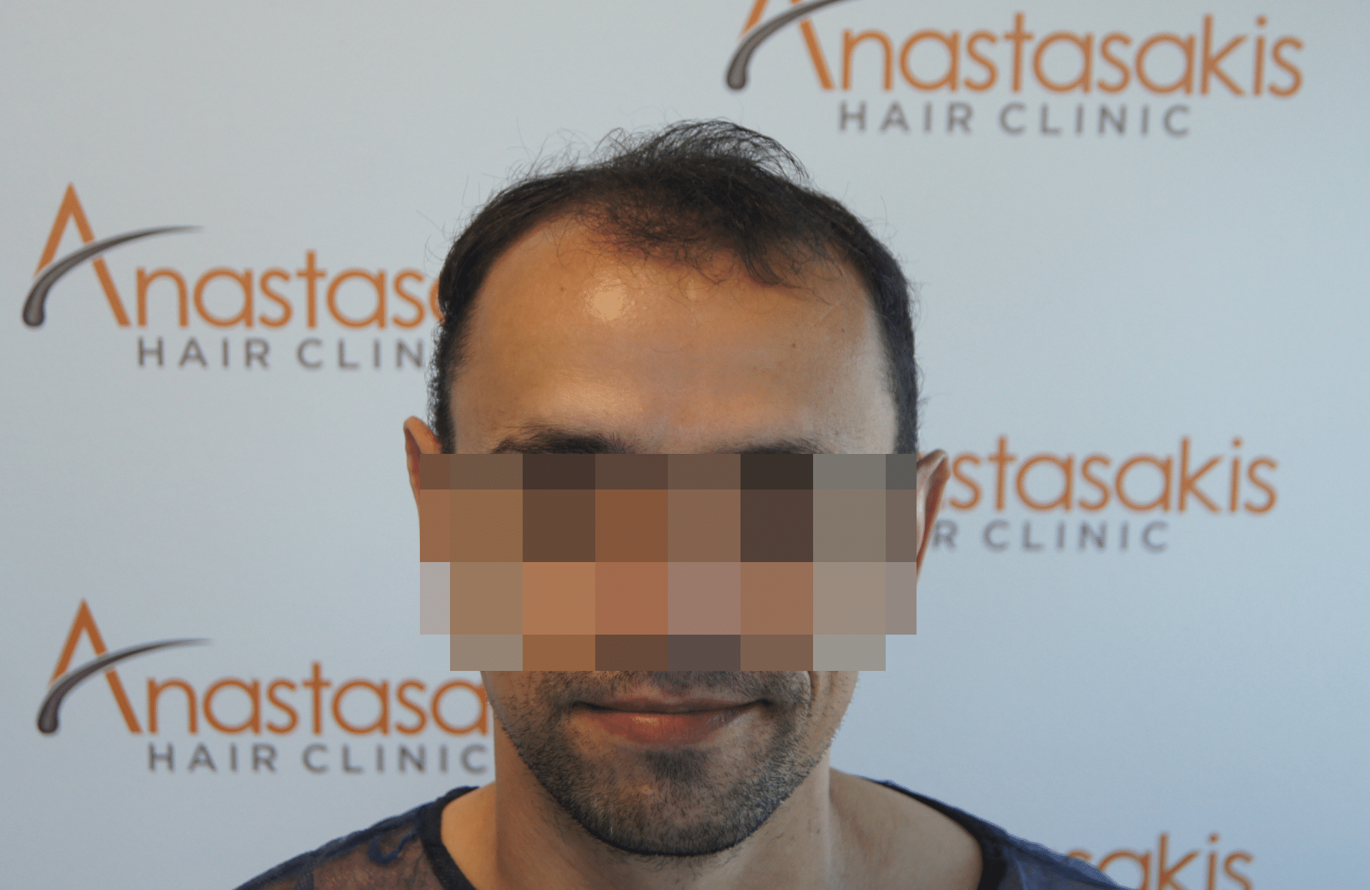 before hair transplant in anastasakis hair clinic fullface_anonymized