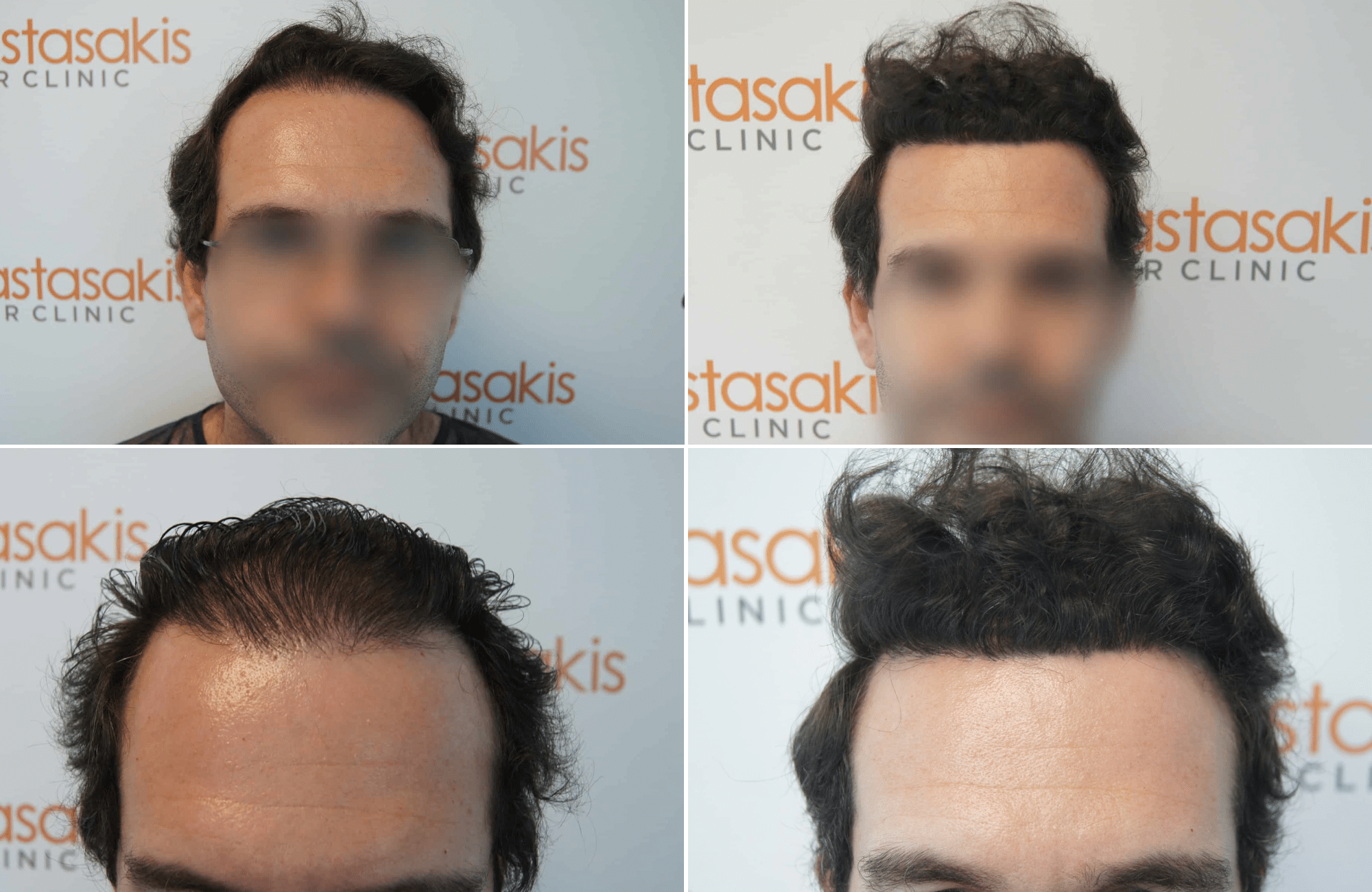 https://www.anastasakishairclinic.gr/portfolio/apotelesma-metamosxefsis-mallion-anastasakis-hair-clinic-353/