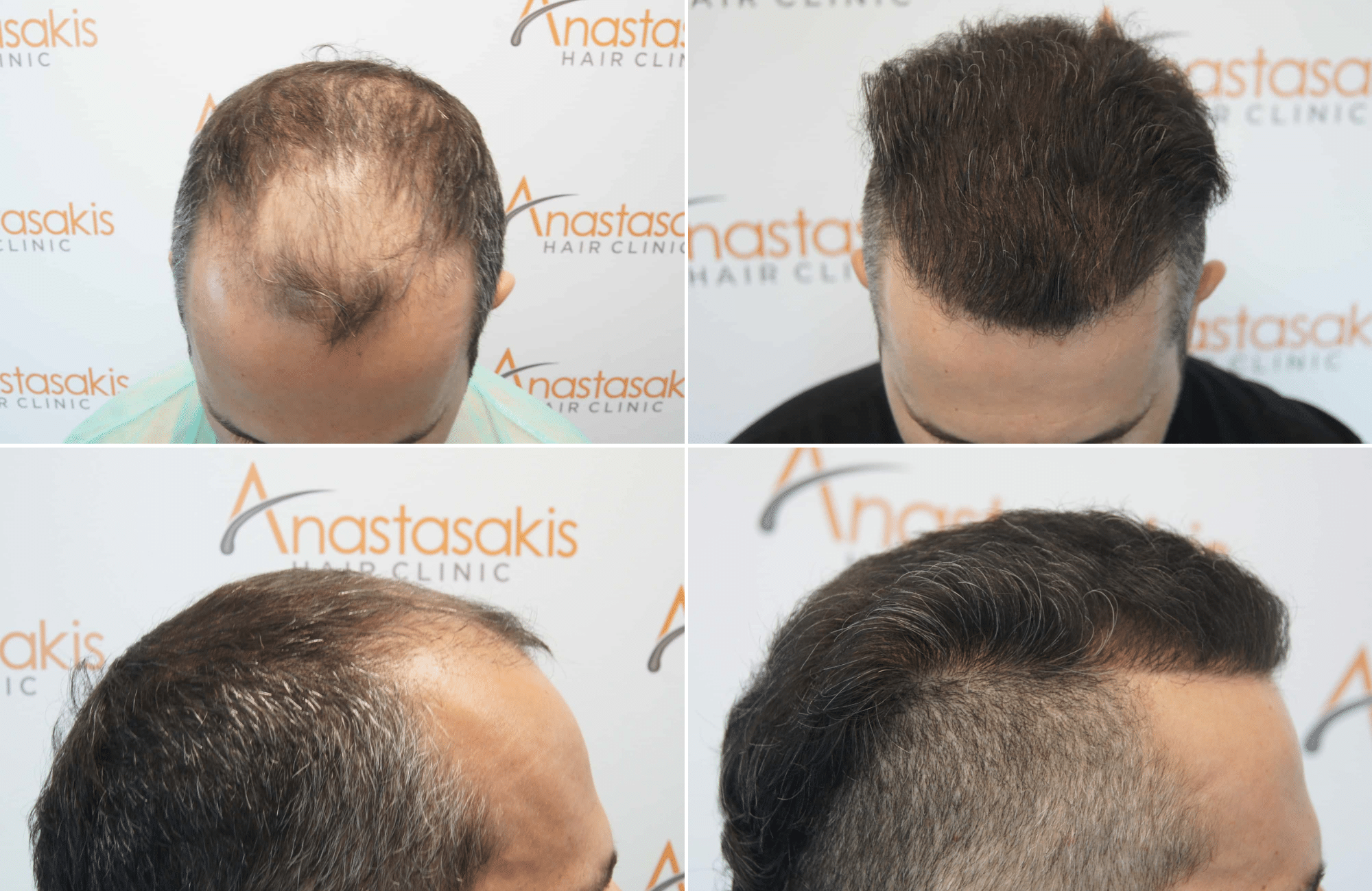 https://www.anastasakishairclinic.gr/portfolio/apotelesma-metamosxefsis-mallion-anastasakis-hair-clinic-322/