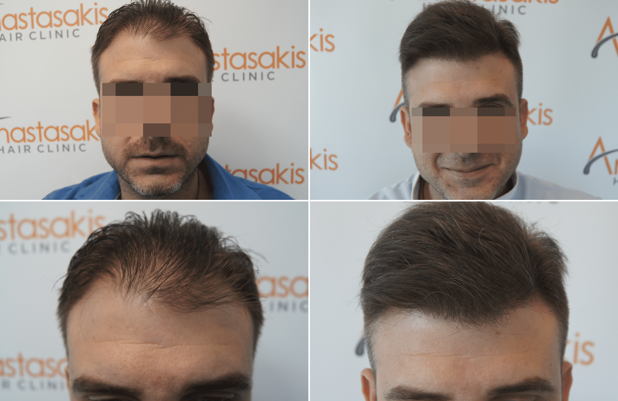 https://www.anastasakishairclinic.gr/portfolio/2600fus-fue-anastasakis-hair-clinic-result/