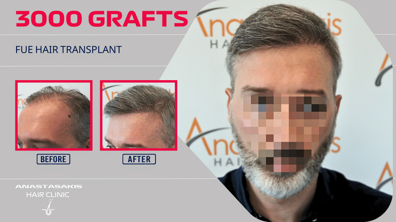hair transplant result with 3000 follicular units anastasakis hair clinic