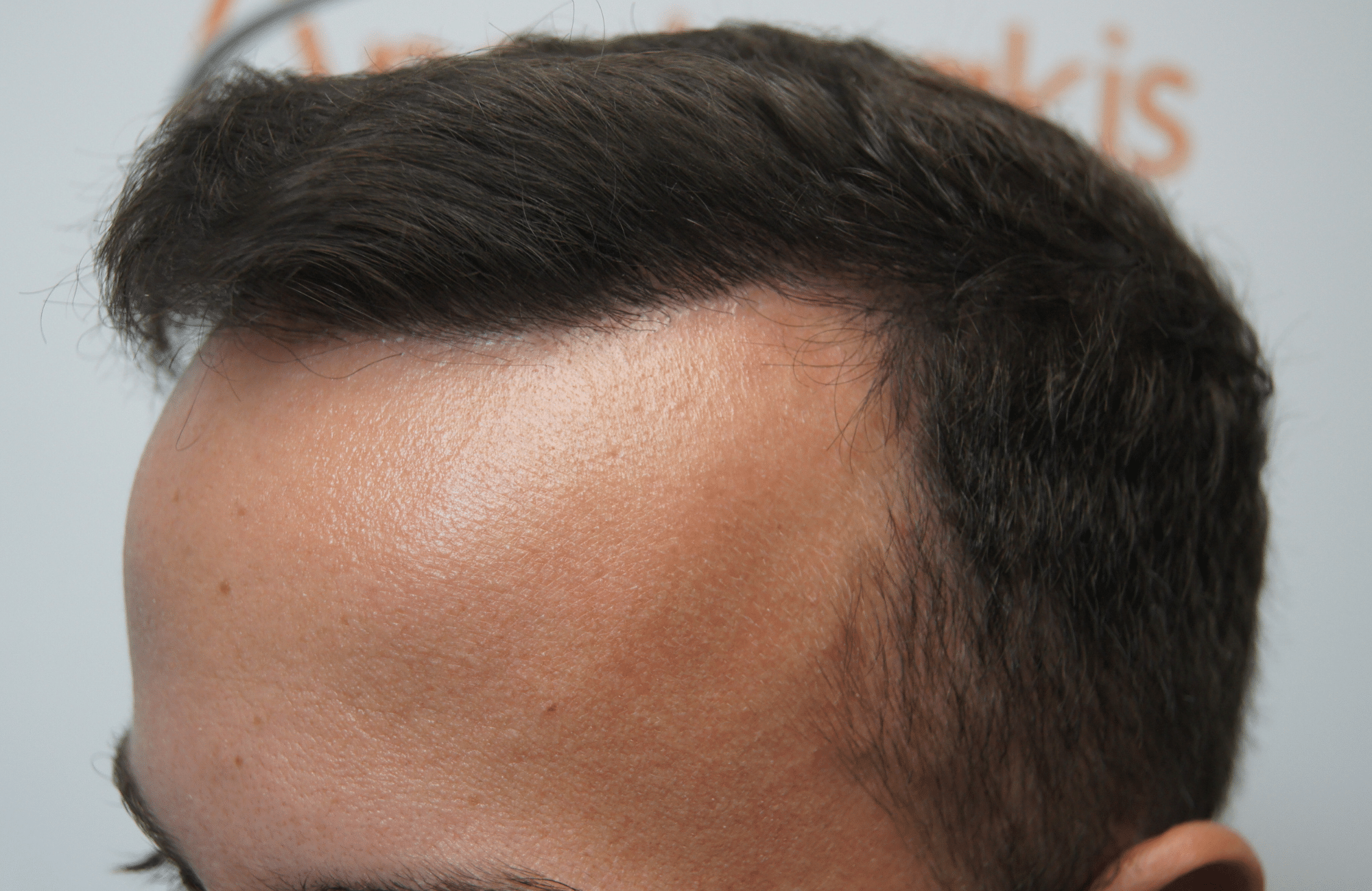 hair transplant resul with 1800 fus fue anastasakis hair clinic