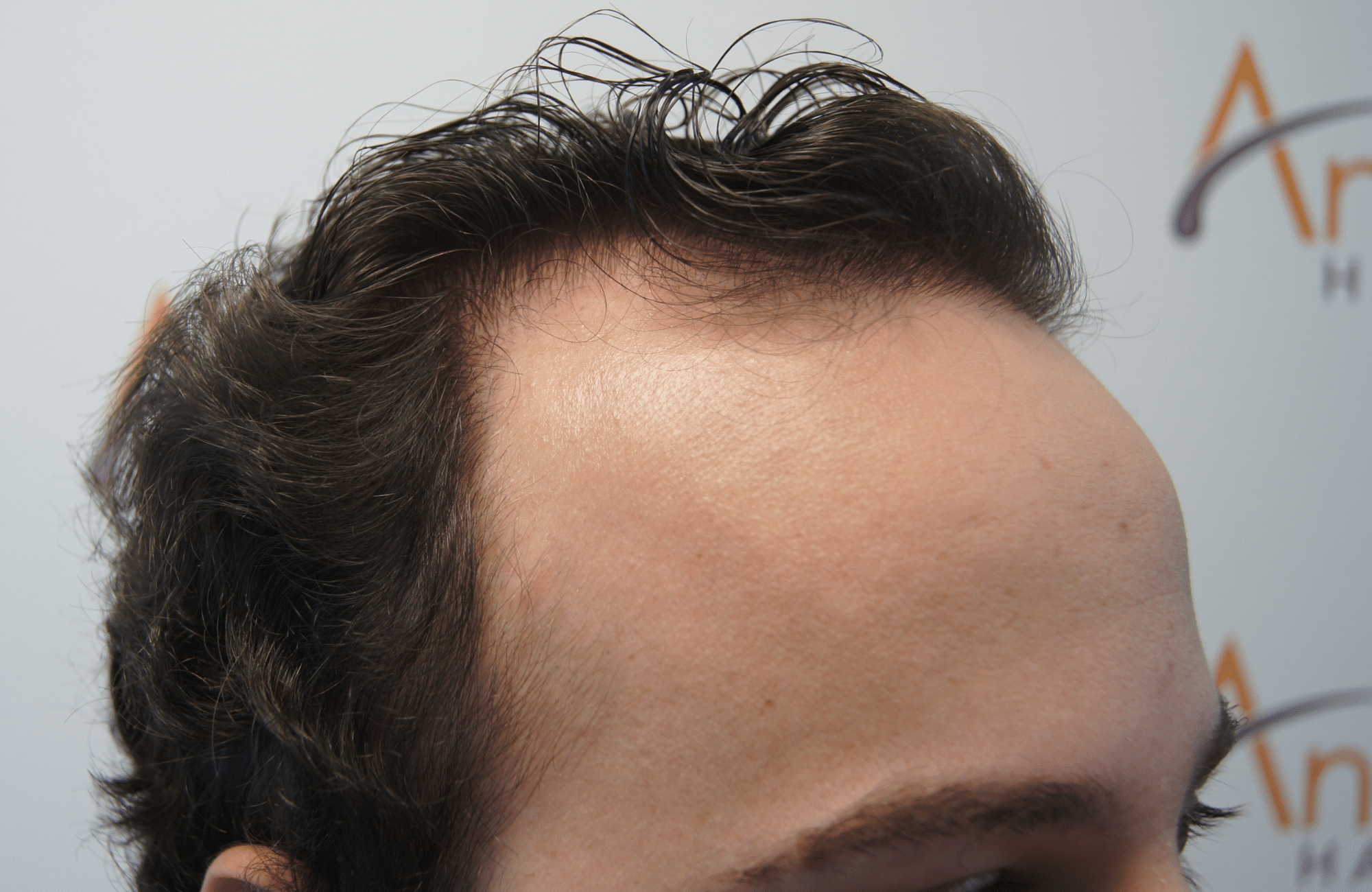 hair transplant resul with 1800 fus fue anastasakis hair clinic