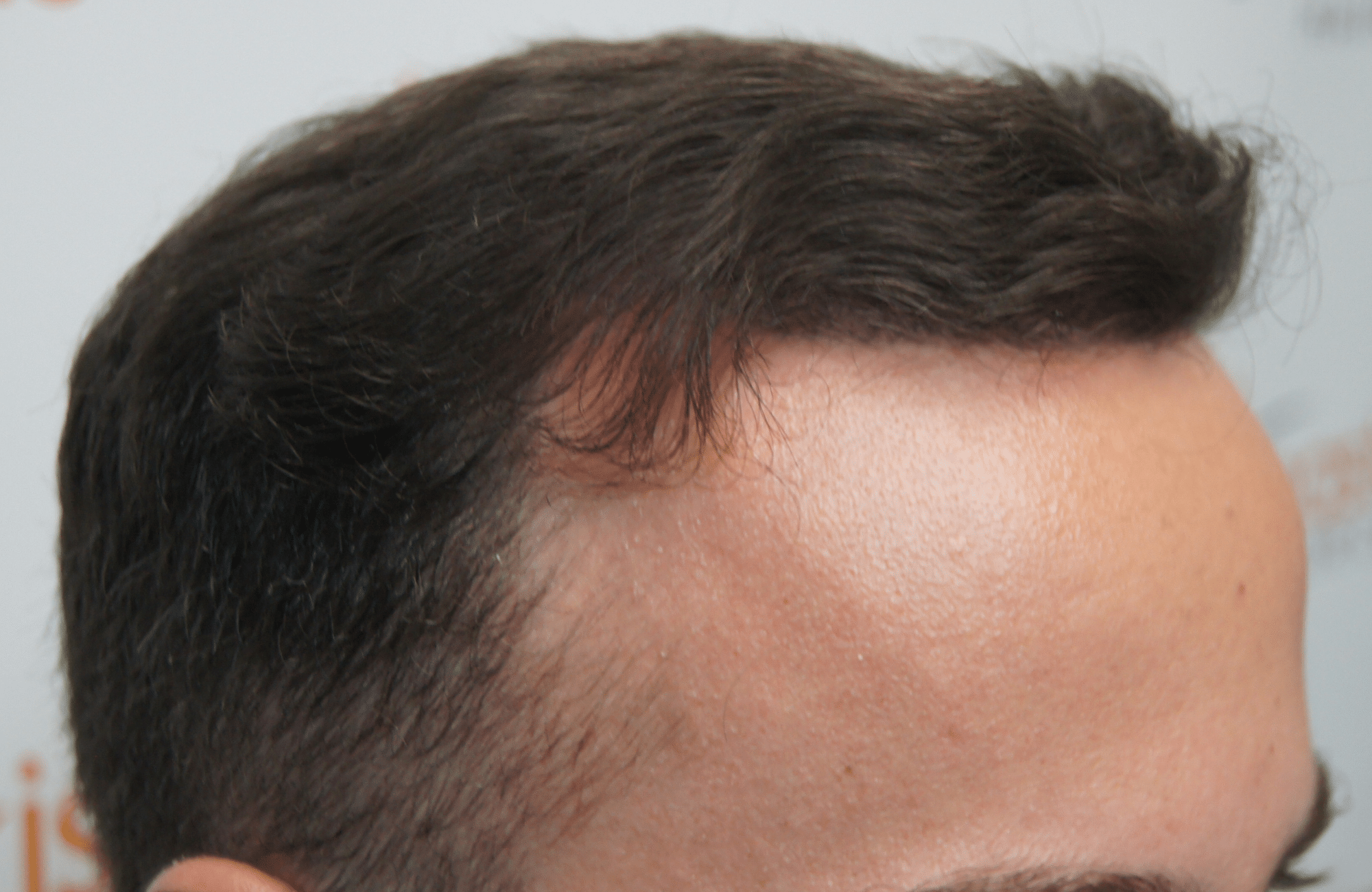 hair transplant resul with 1800 fus fue anastasakis hair clinic
