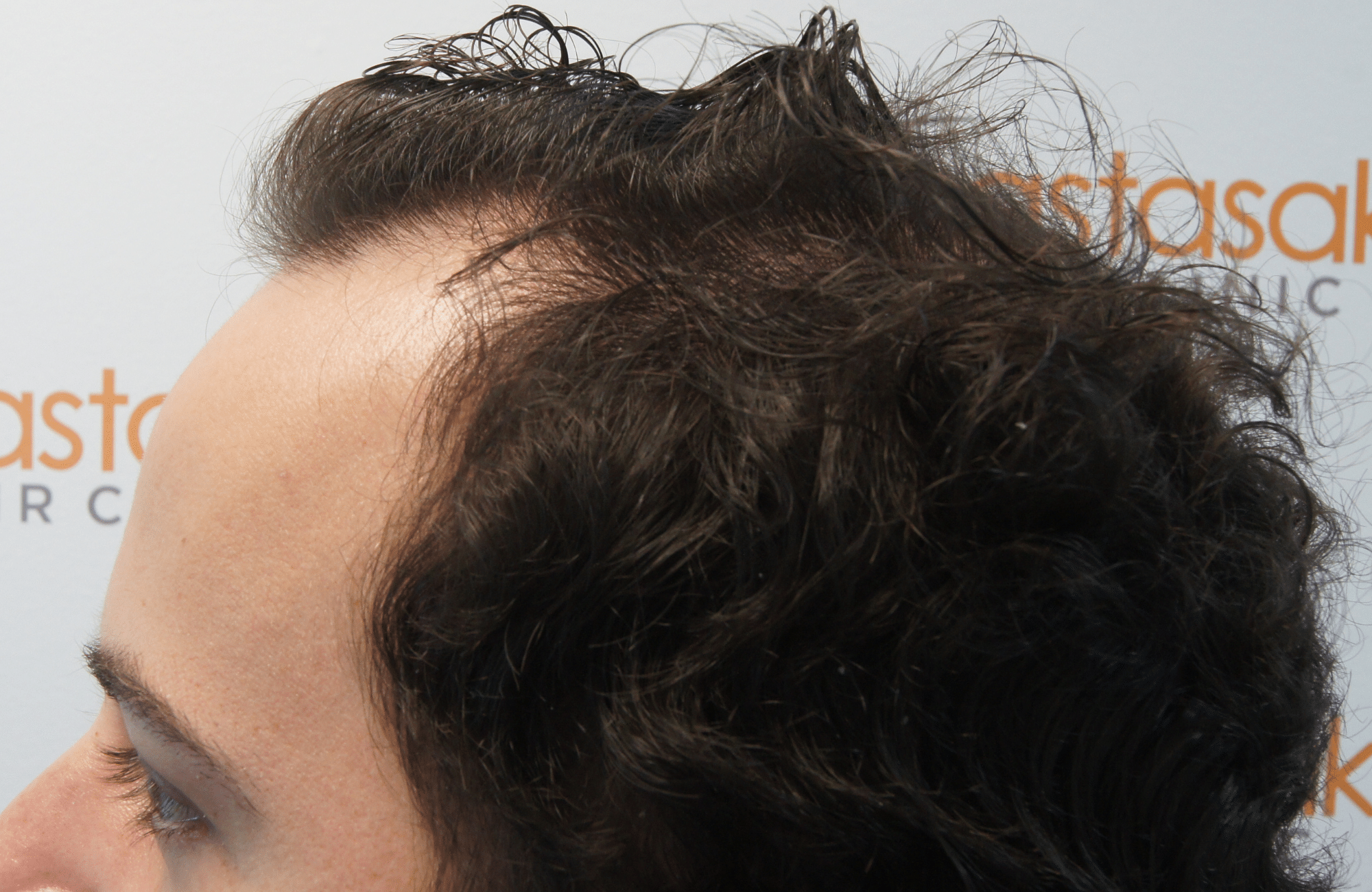 hair transplant resul with 1800 fus fue anastasakis hair clinic