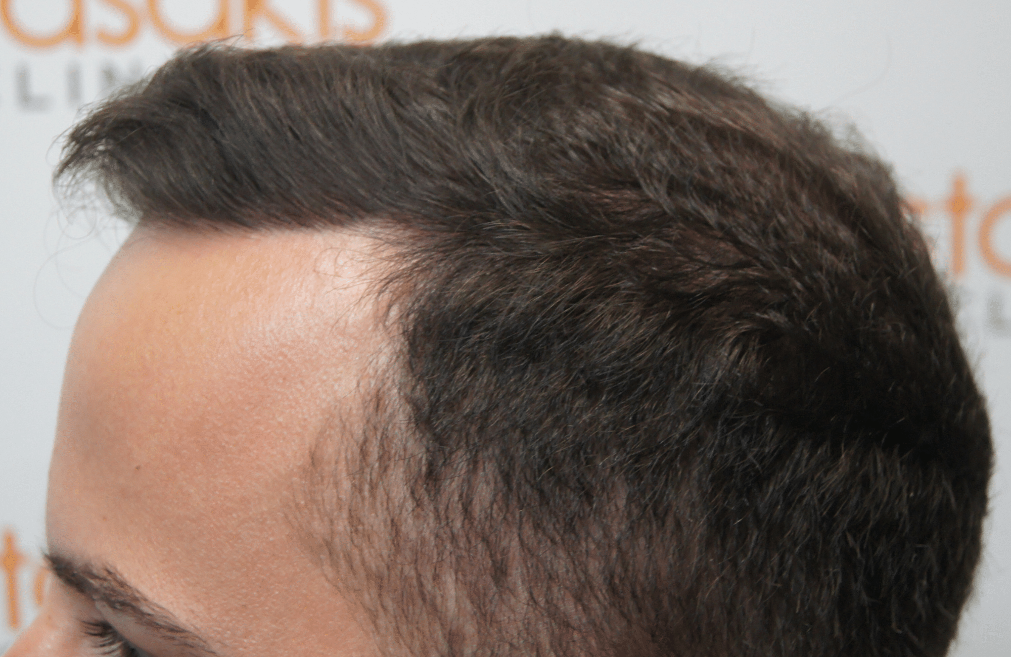 hair transplant resul with 1800 fus fue anastasakis hair clinic