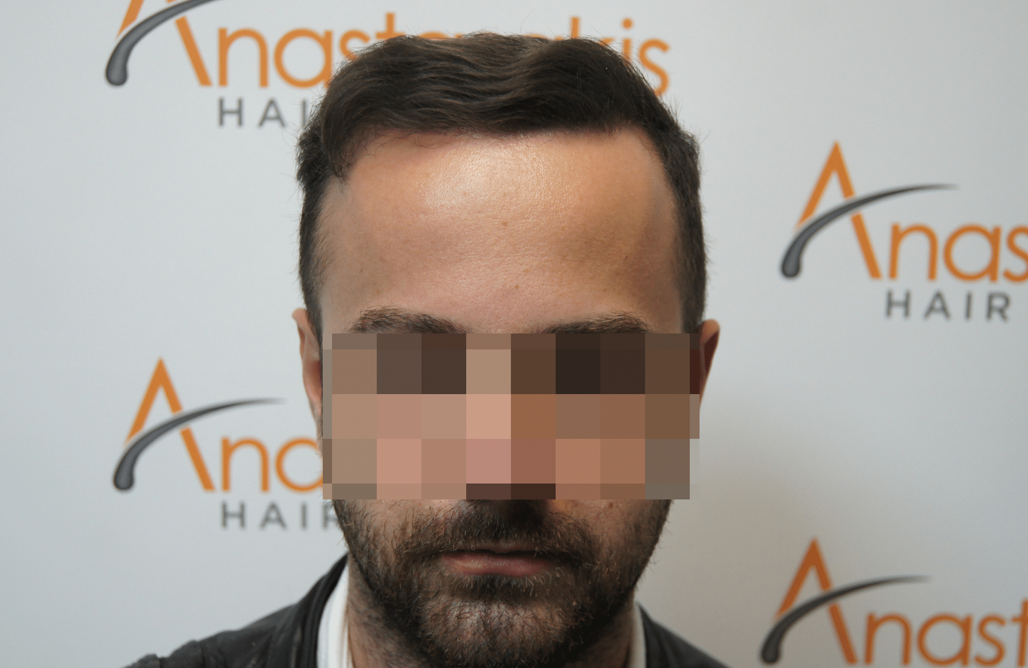 hair transplant resul with 1800 fus fue anastasakis hair clinic