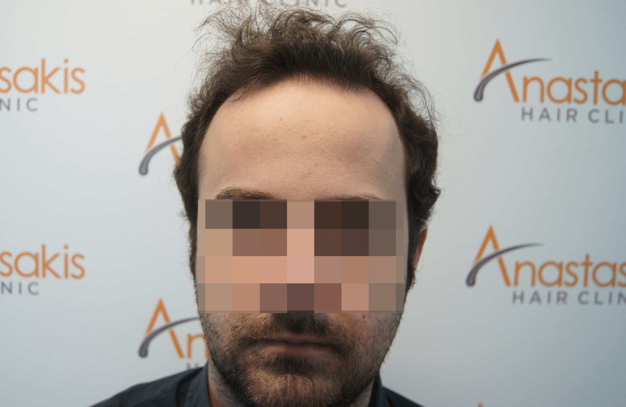 hair transplant resul with 1800 fus fue anastasakis hair clinic