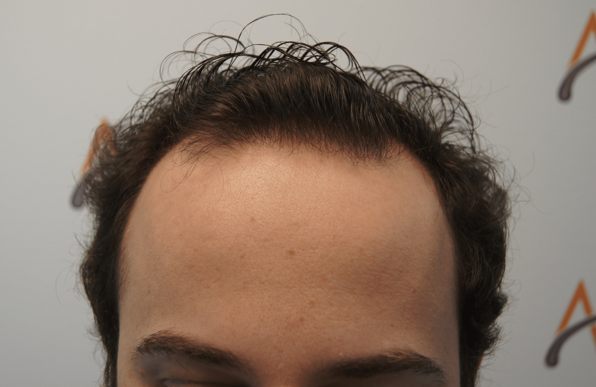 hair transplant resul with 1800 fus fue anastasakis hair clinic