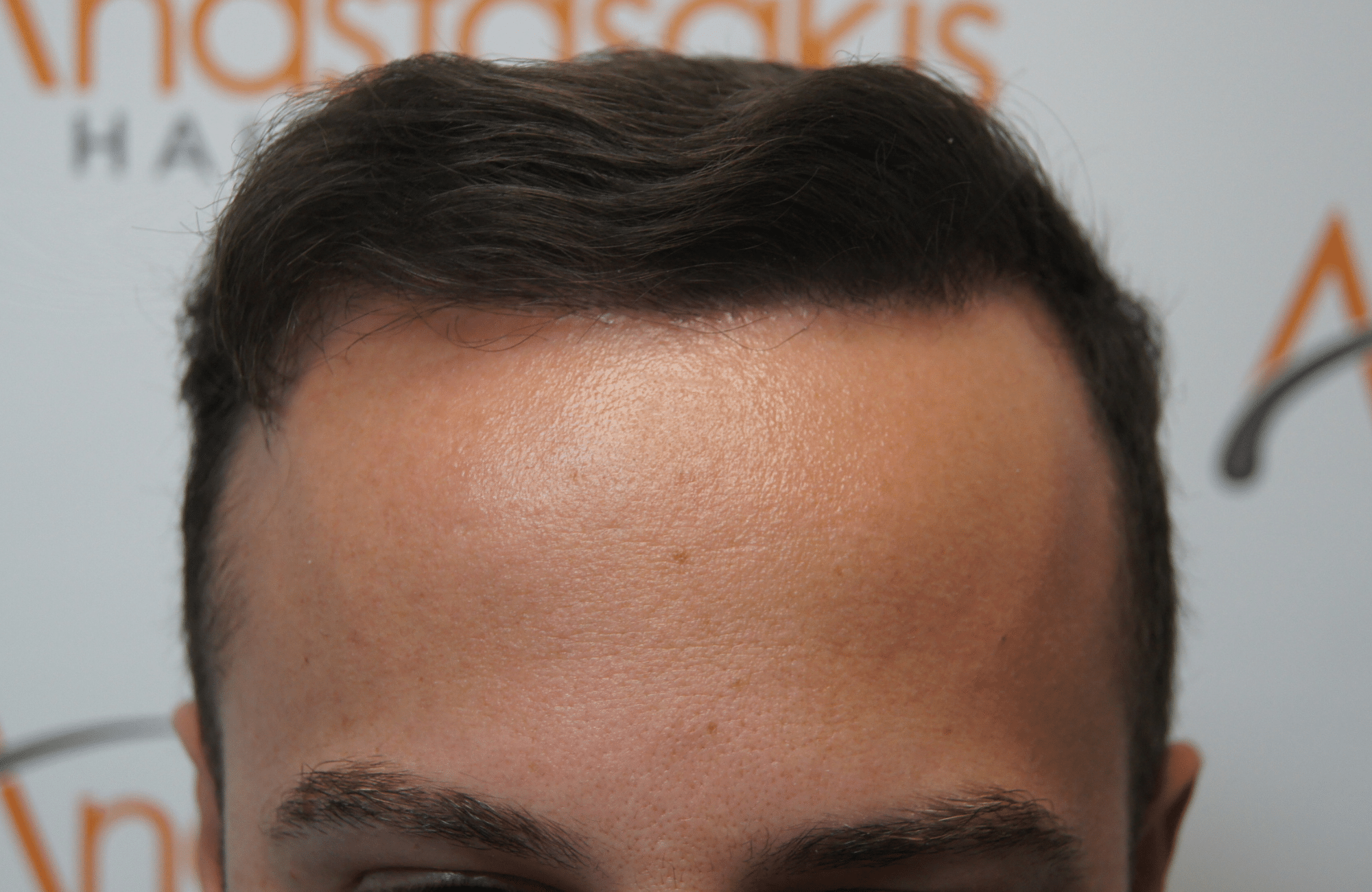 hair transplant resul with 1800 fus fue anastasakis hair clinic