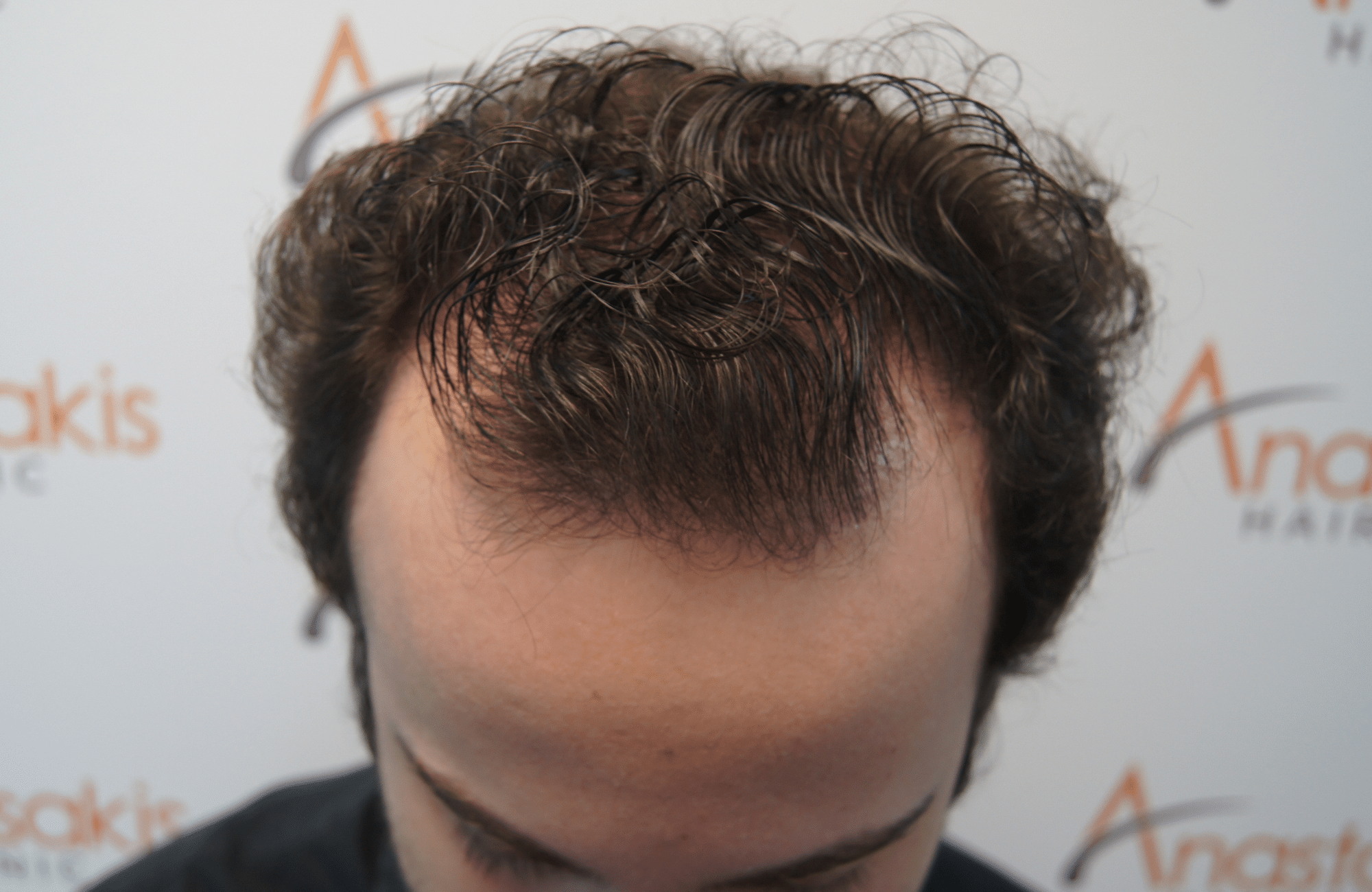 hair transplant resul with 1800 fus fue anastasakis hair clinic