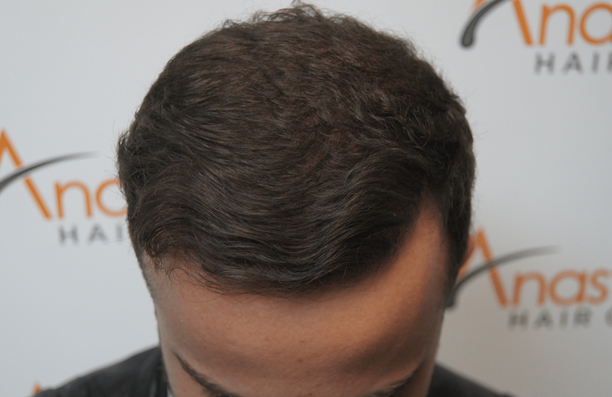 hair transplant resul with 1800 fus fue anastasakis hair clinic