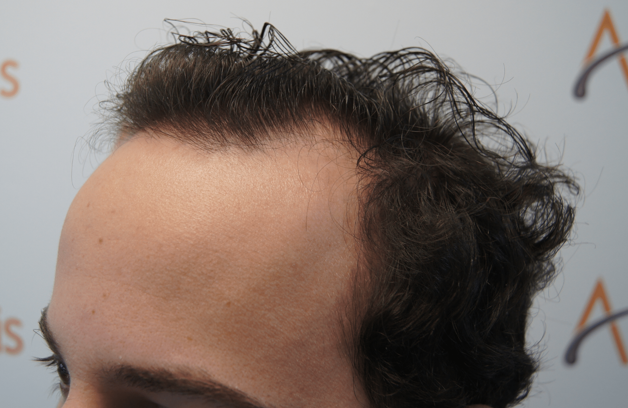 hair transplant resul with 1800 fus fue anastasakis hair clinic