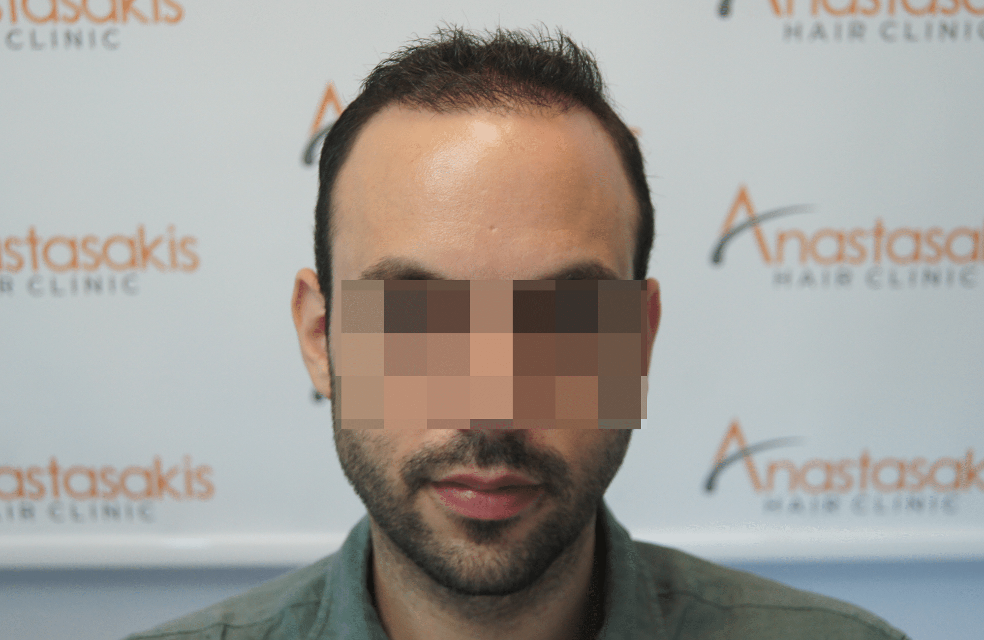 hair transplant resul with 1700 fus fue anastasakis hair clinic
