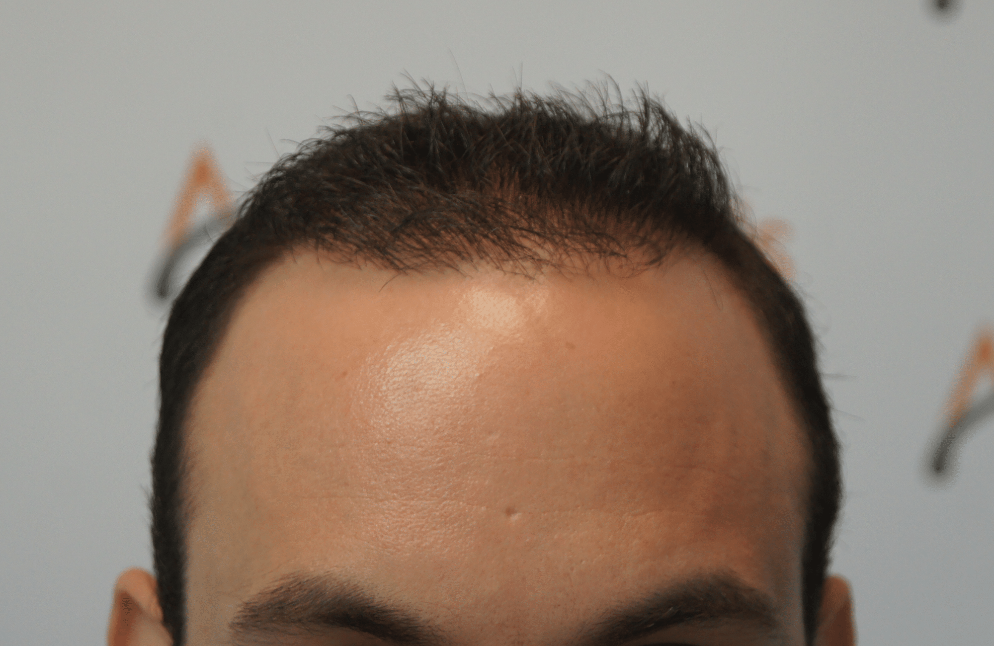 hair transplant resul with 1700 fus fue anastasakis hair clinic