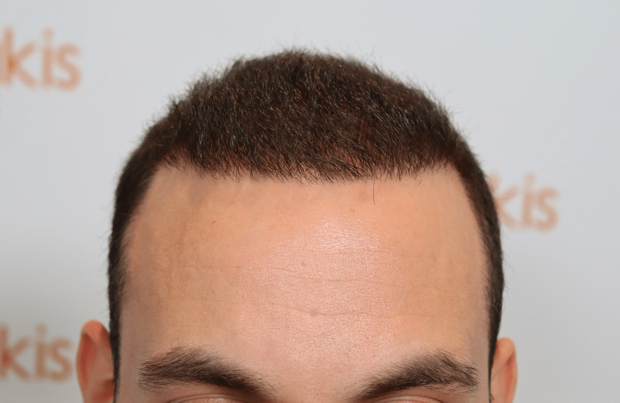 hair transplant resul with 1700 fus fue anastasakis hair clinic