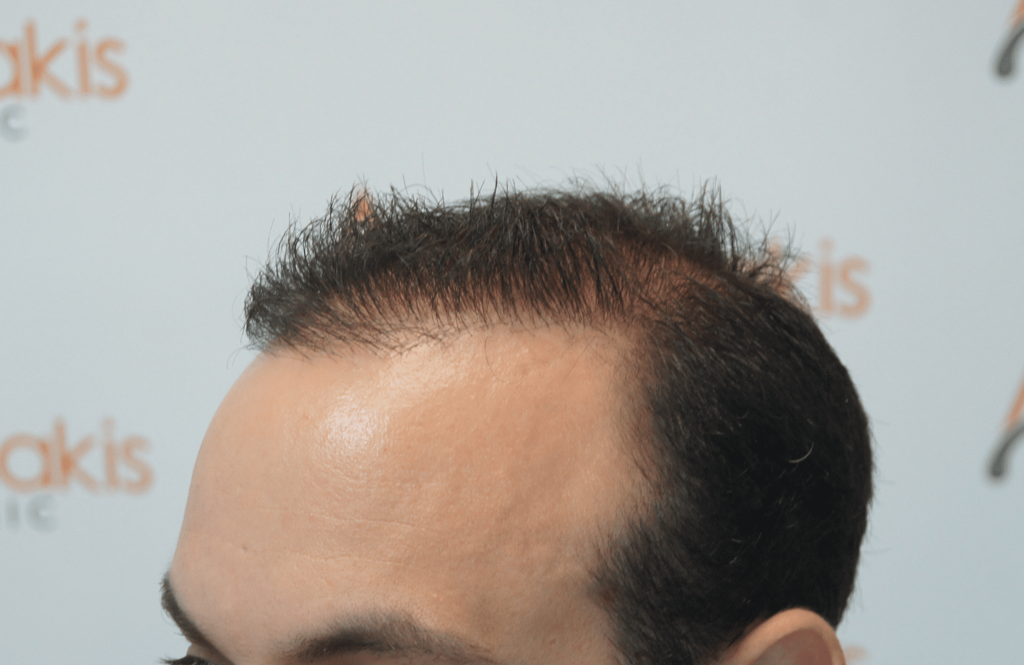 hair transplant resul with 1700 fus fue anastasakis hair clinic