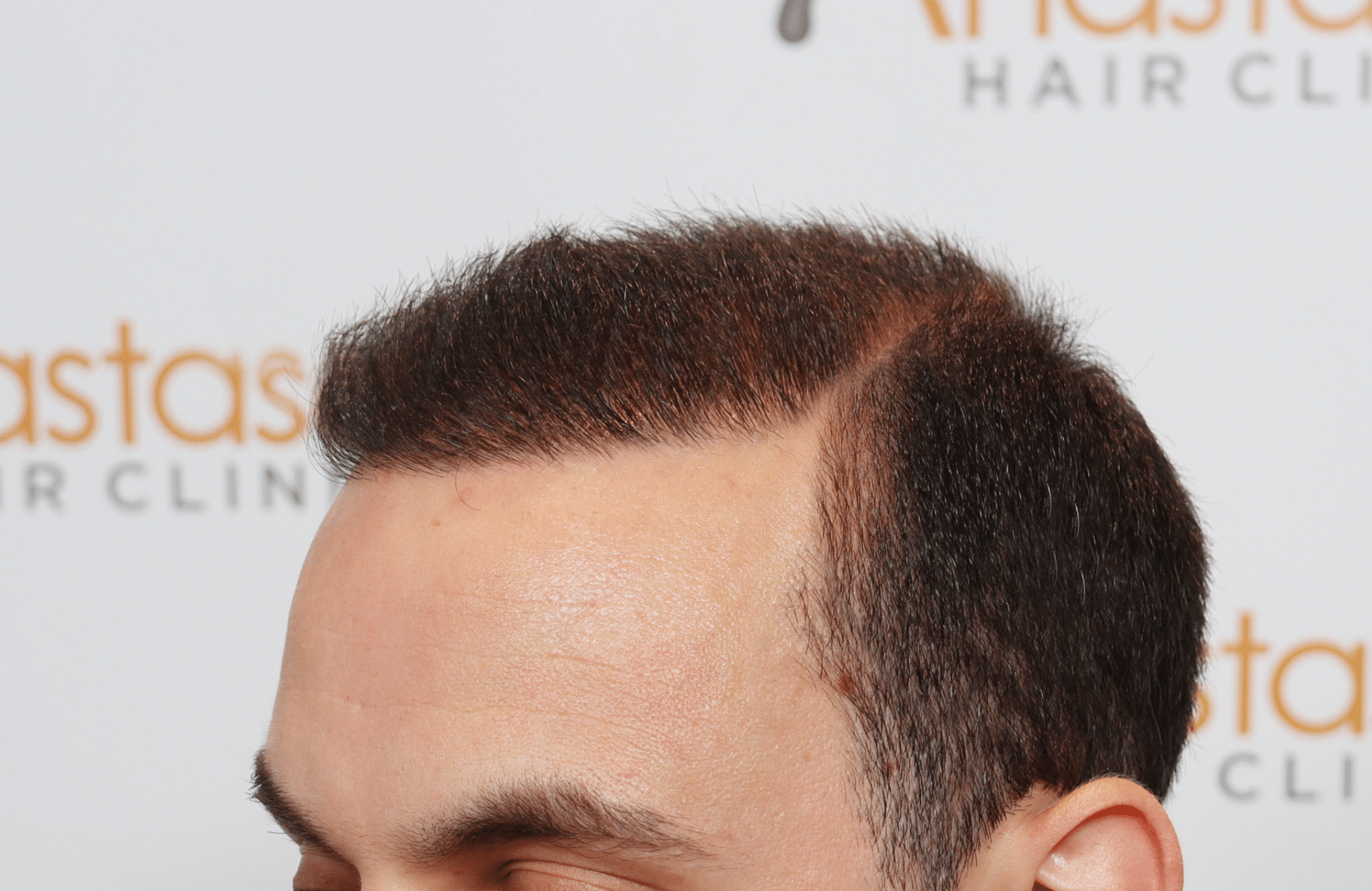 hair transplant resul with 1700 fus fue anastasakis hair clinic